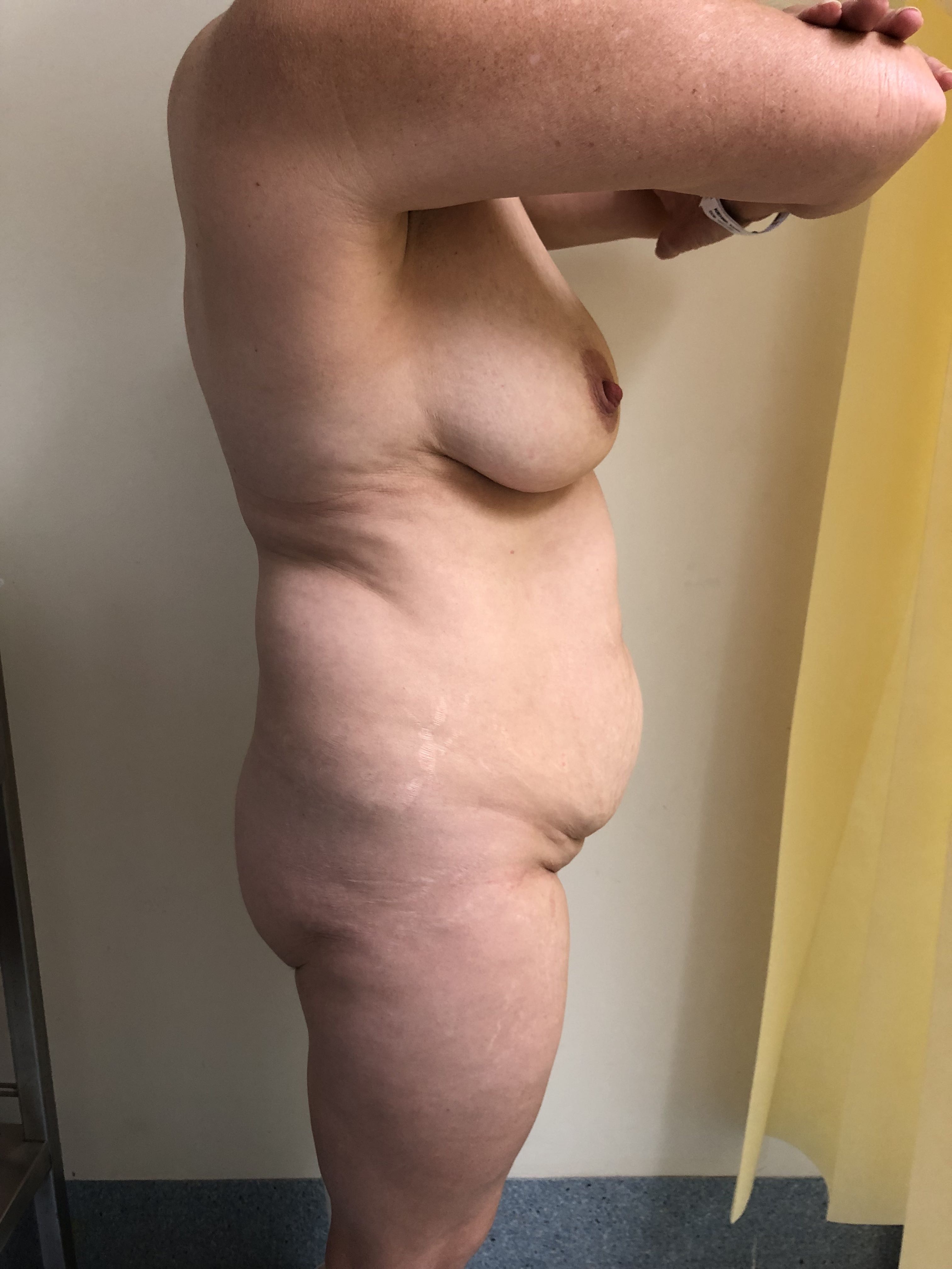 Abdominoplasty (Tummy Tuck) clinical image 30