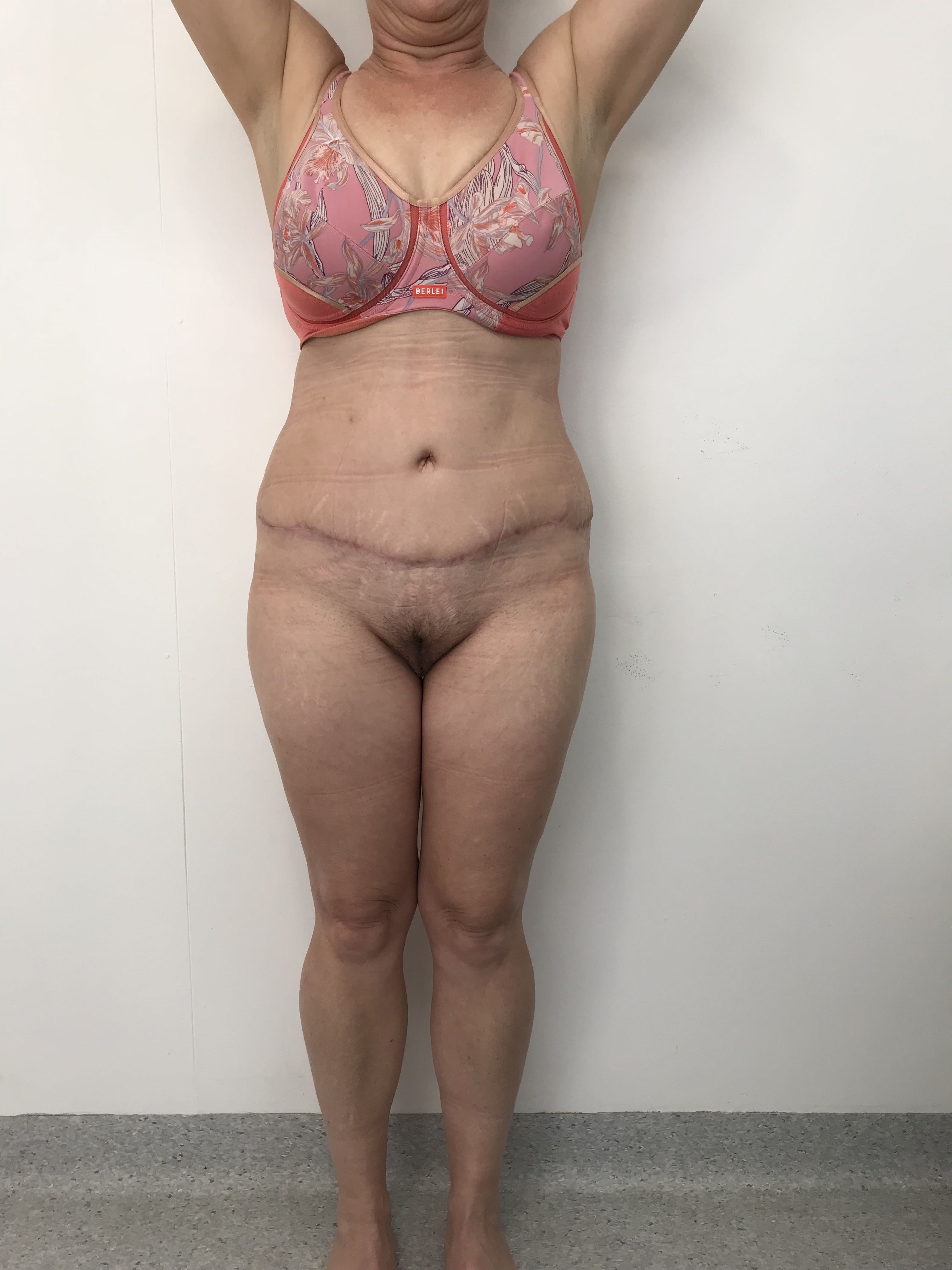 Abdominoplasty (Tummy Tuck) clinical image 31