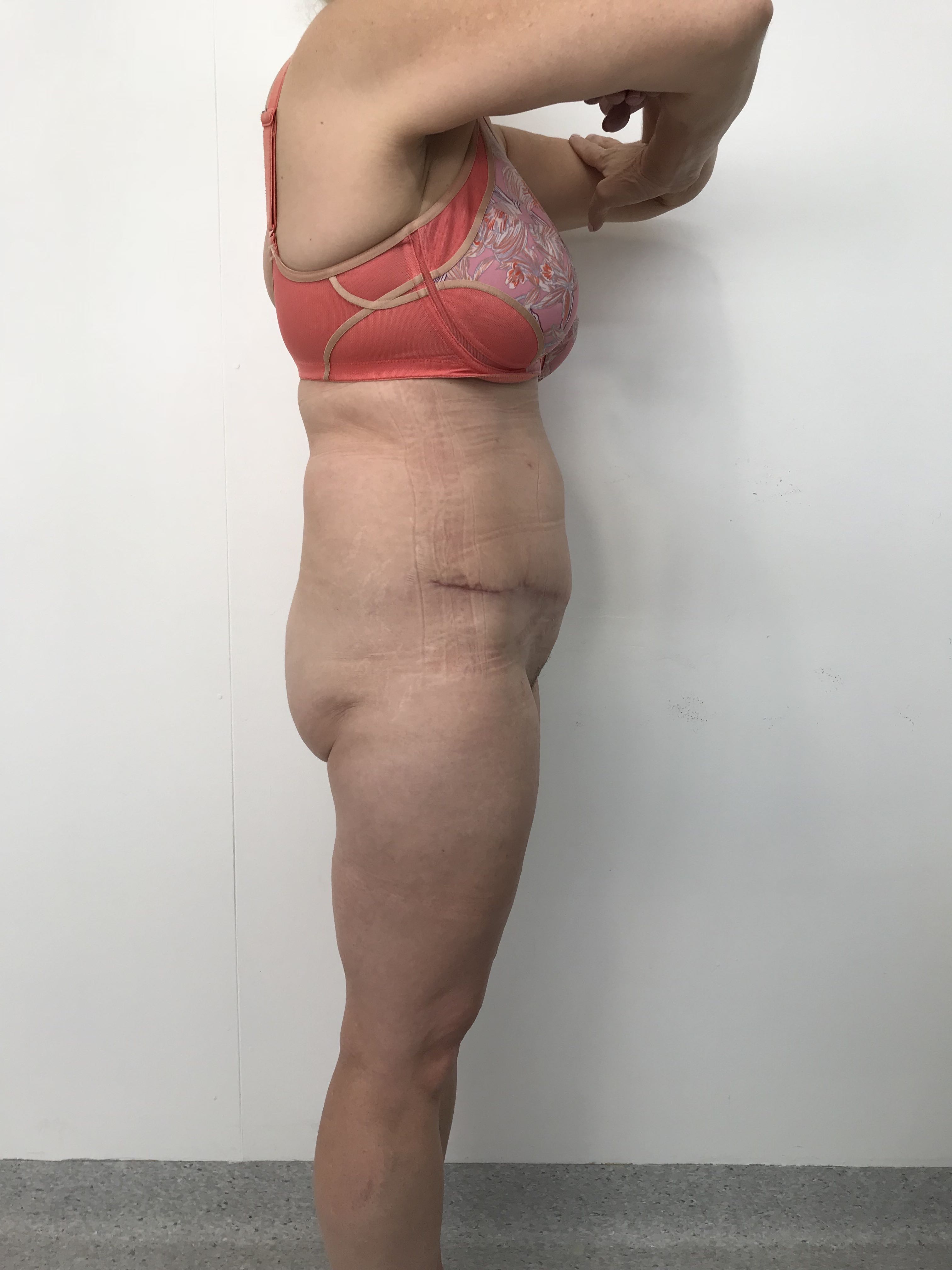 Abdominoplasty (Tummy Tuck) clinical image 32