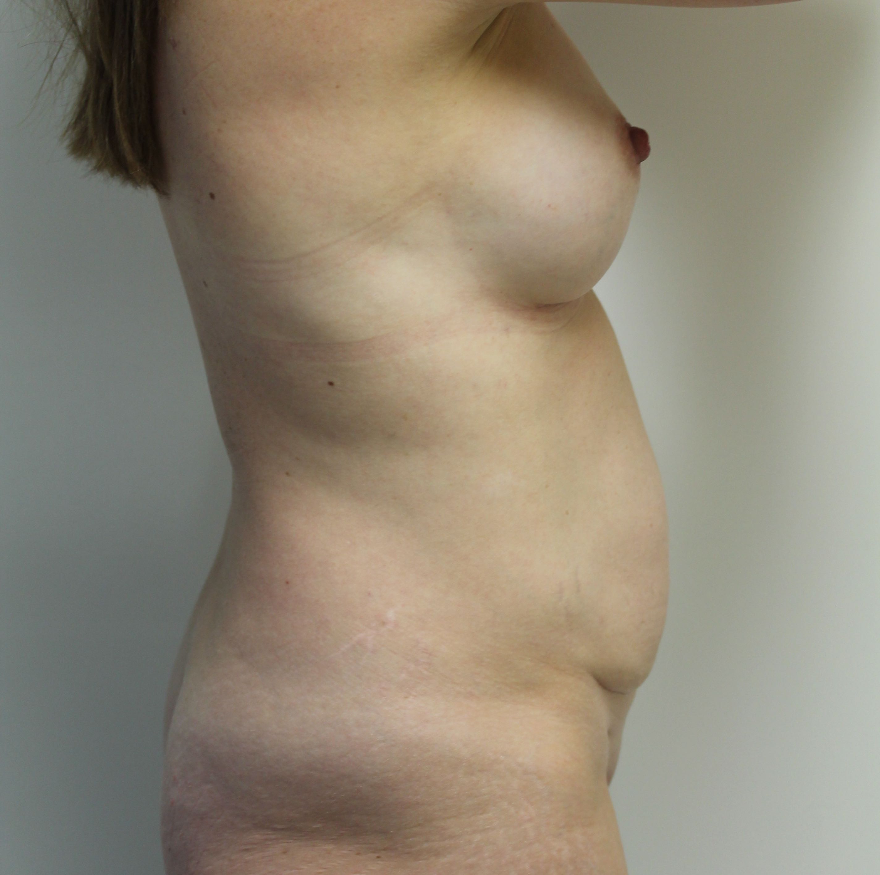Abdominoplasty (Tummy Tuck) clinical image 34