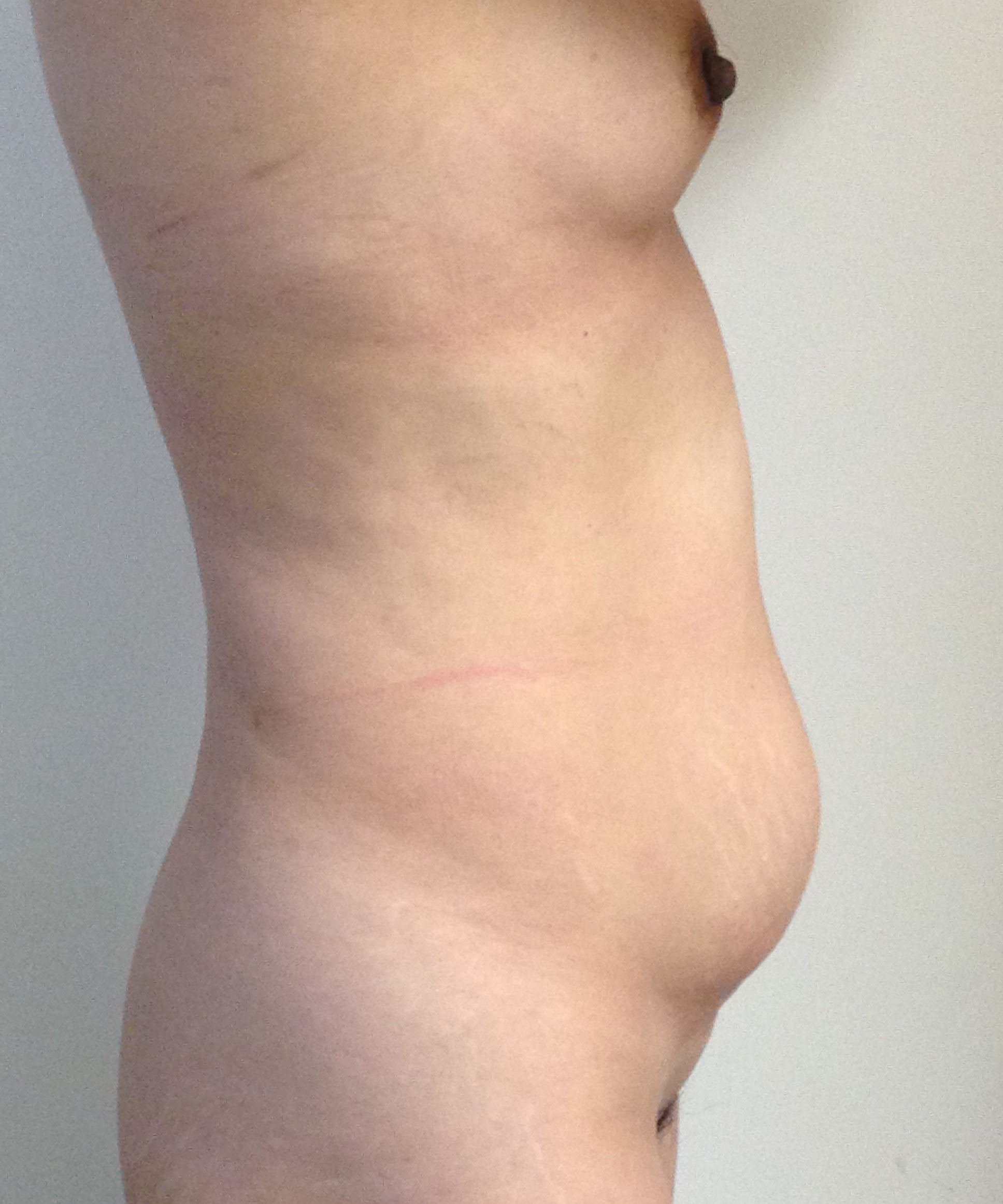Abdominoplasty (Tummy Tuck) clinical image 38