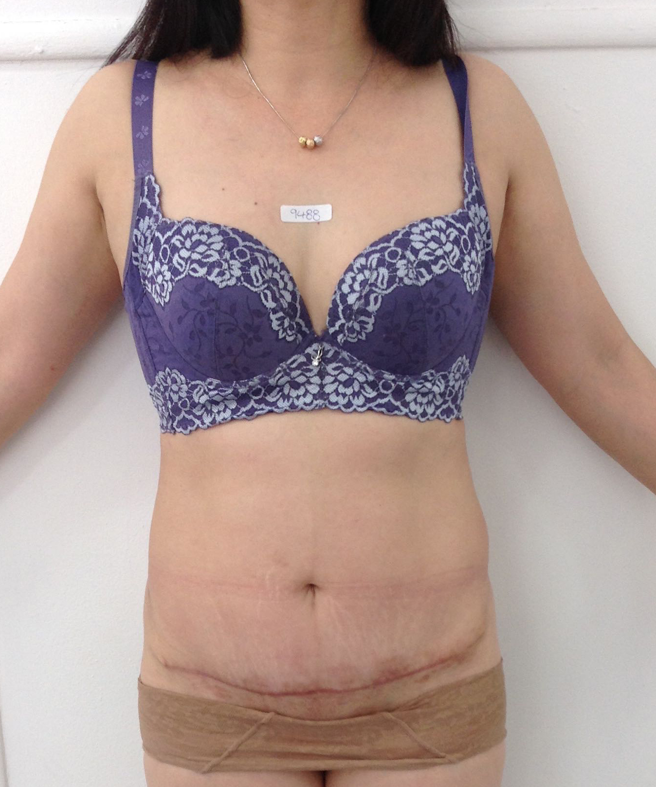 Abdominoplasty (Tummy Tuck) clinical image 39