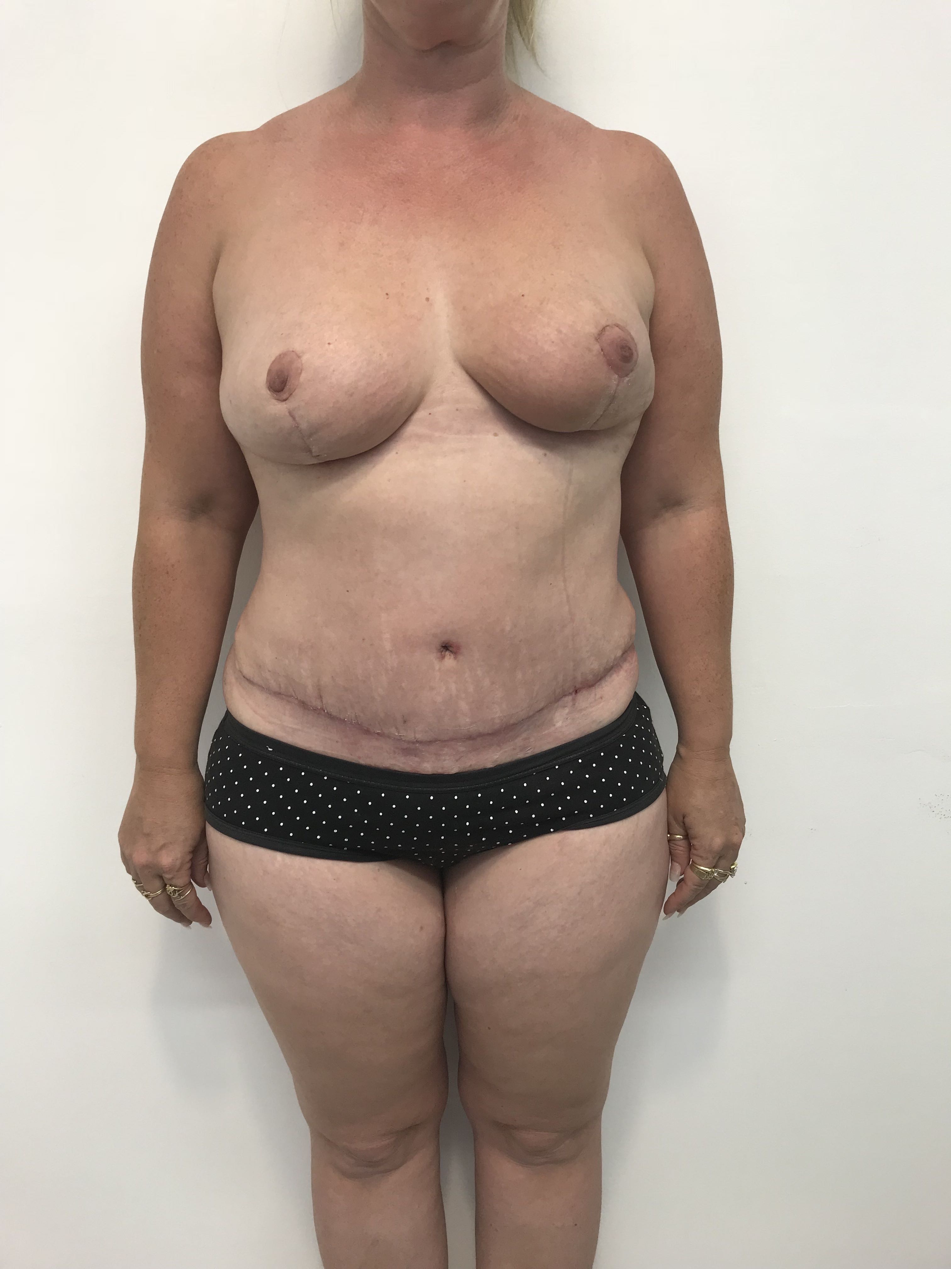 Abdominoplasty (Tummy Tuck) clinical image 3