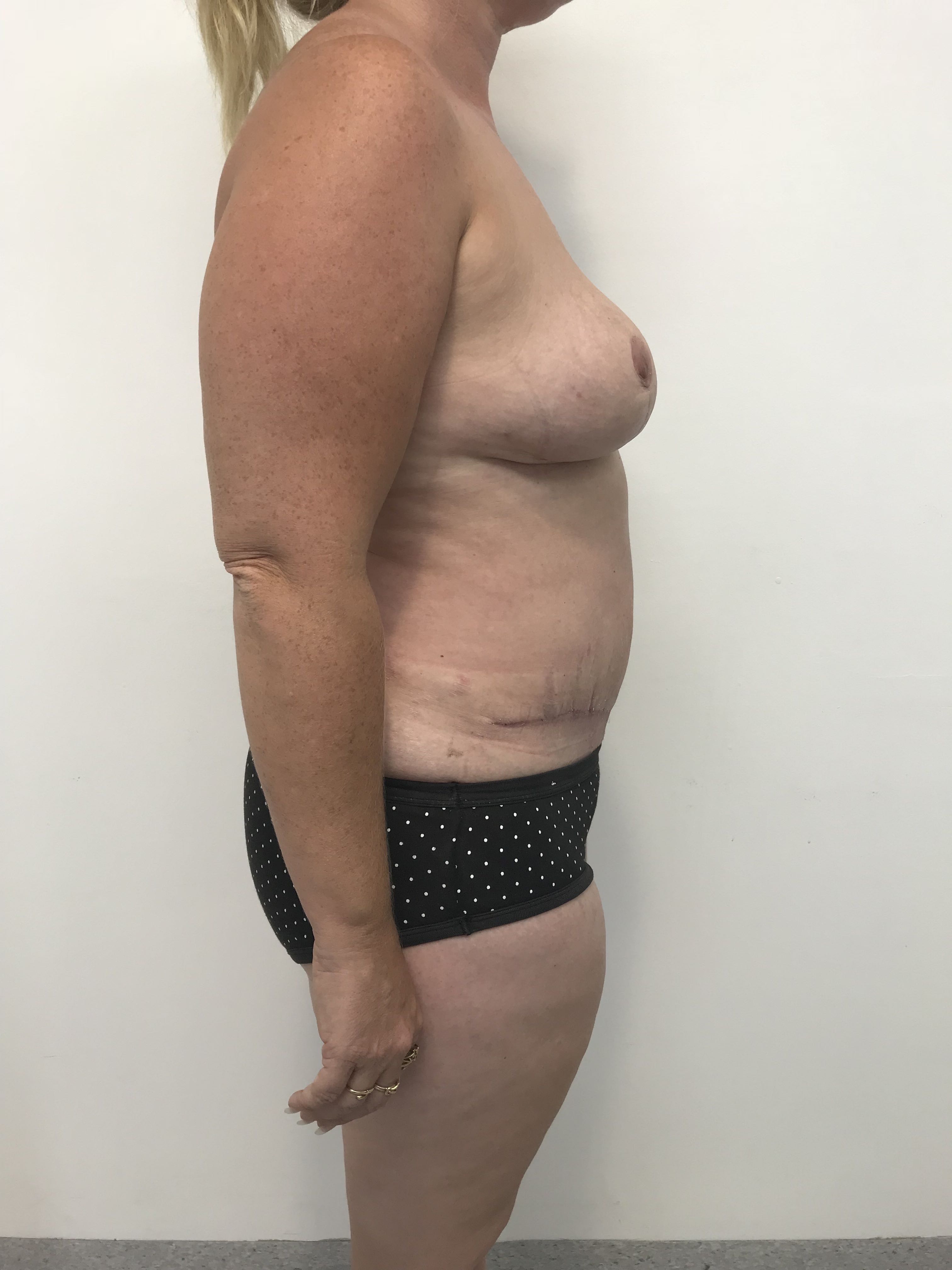Abdominoplasty (Tummy Tuck) clinical image 4
