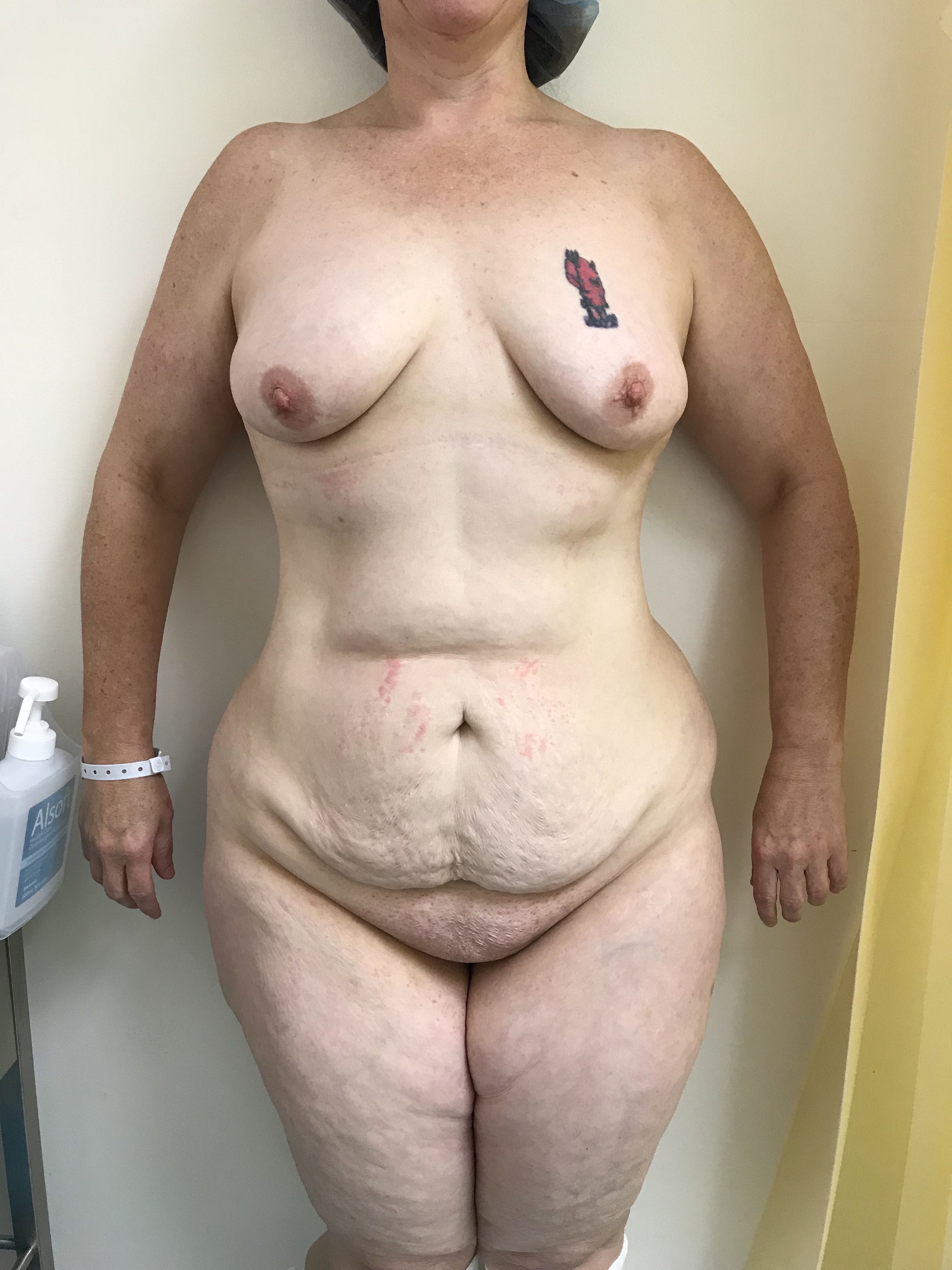 Abdominoplasty (Tummy Tuck) clinical image 5