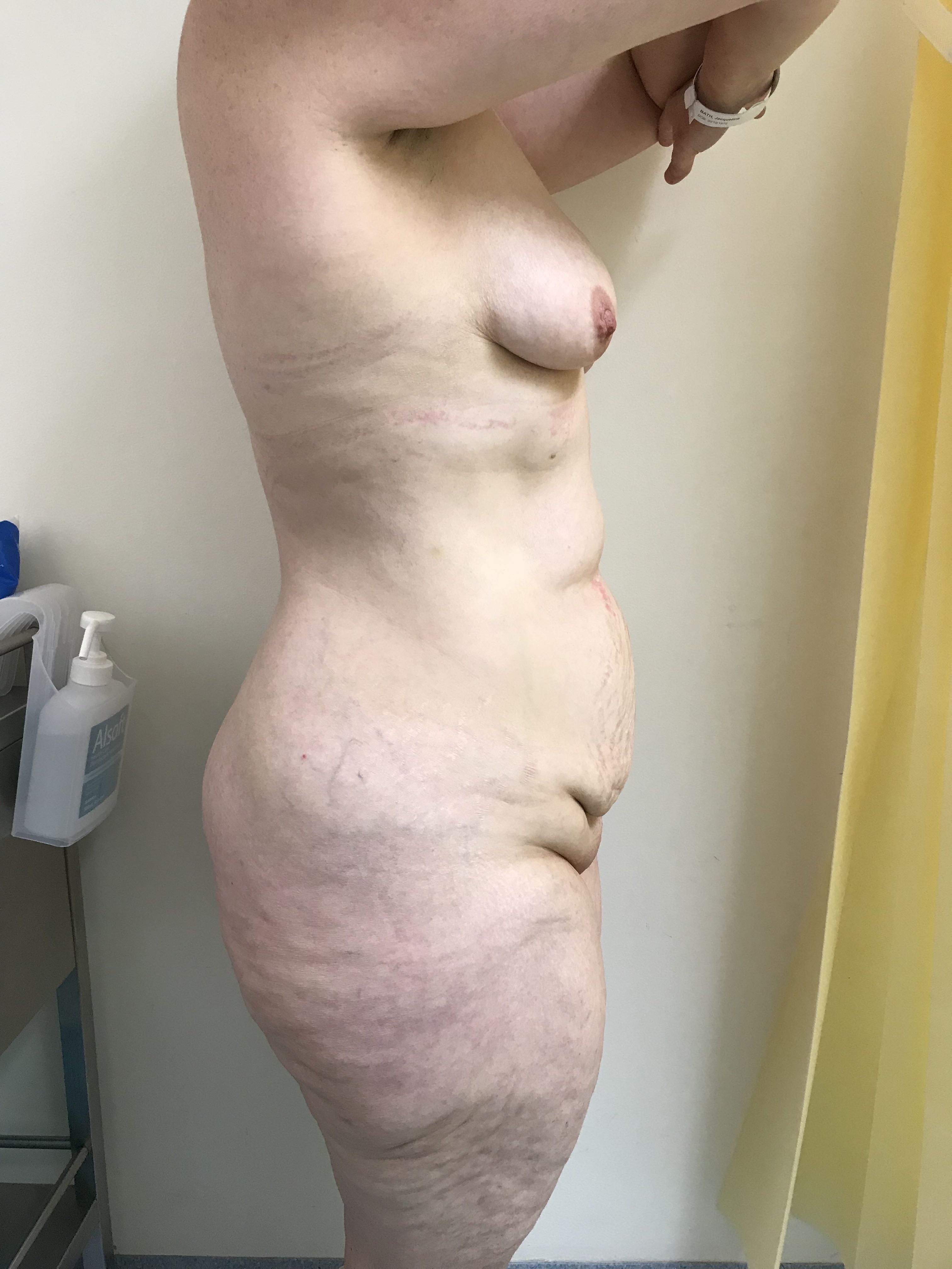 Abdominoplasty (Tummy Tuck) clinical image 6