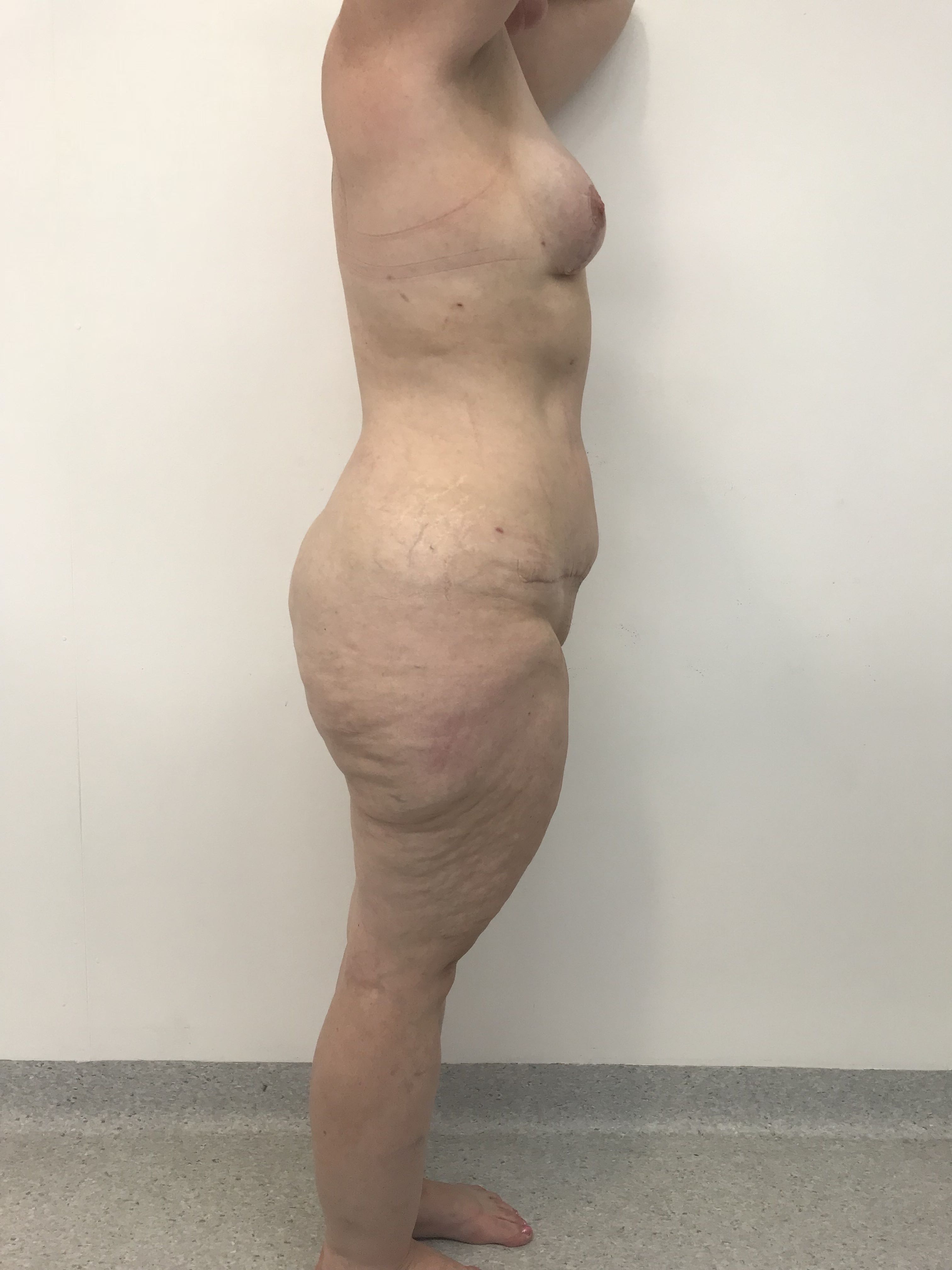 Abdominoplasty (Tummy Tuck) clinical image 8