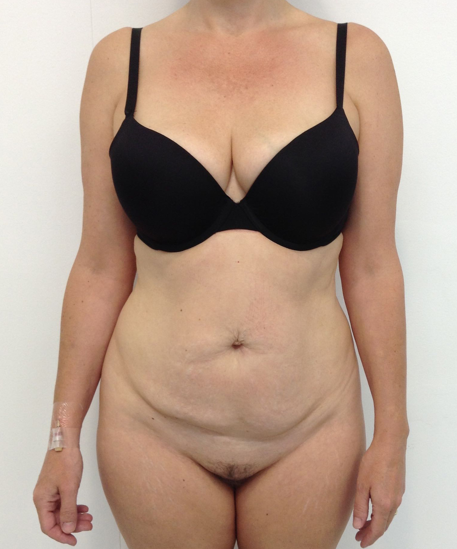 Abdominoplasty (Tummy Tuck) clinical image 9