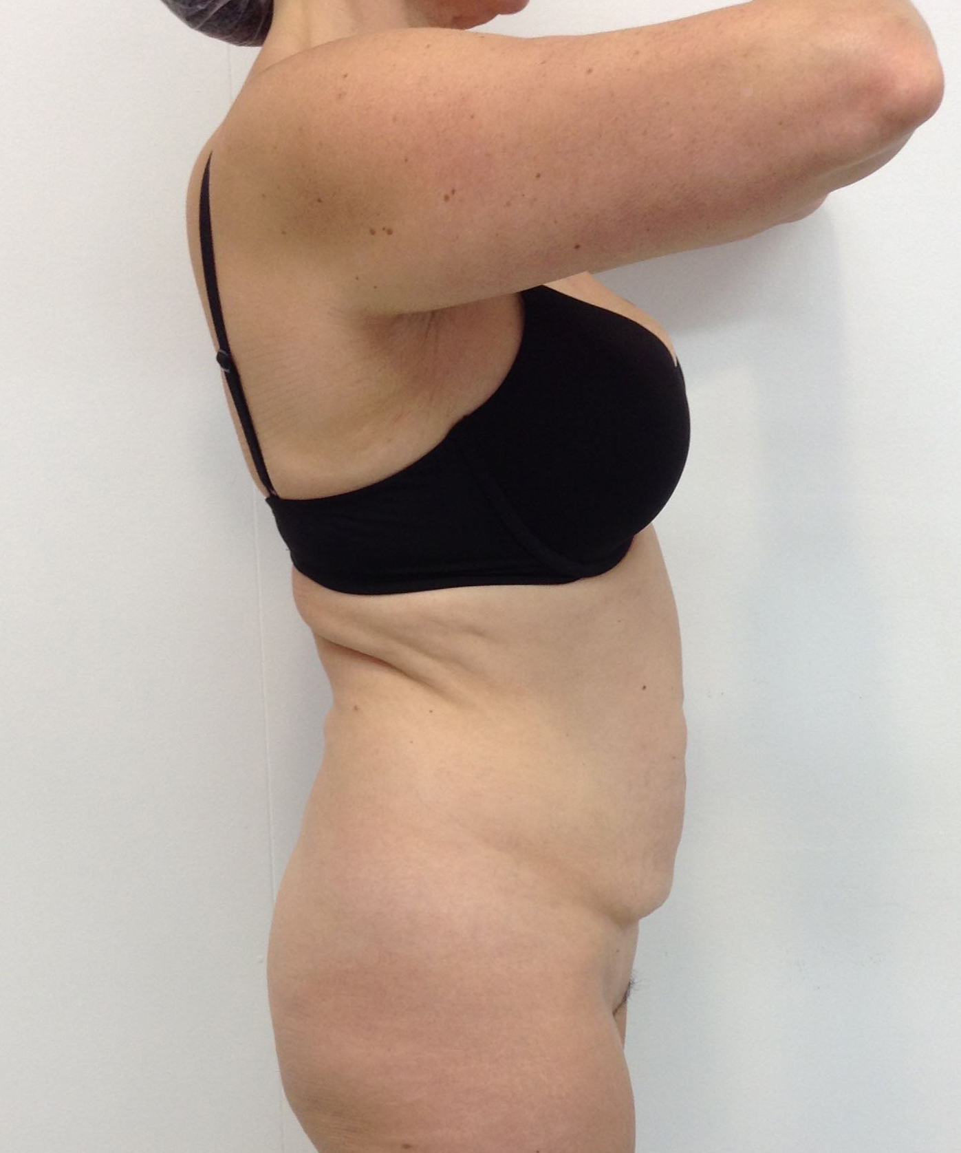 Abdominoplasty (Tummy Tuck) clinical image 10
