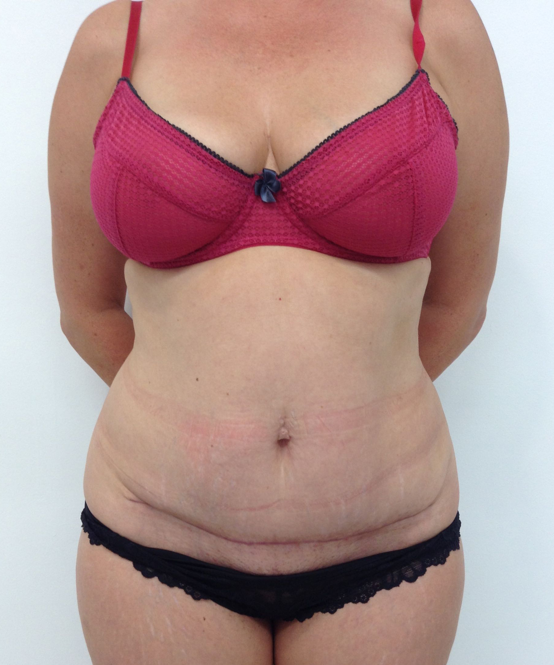 Abdominoplasty (Tummy Tuck) clinical image 11