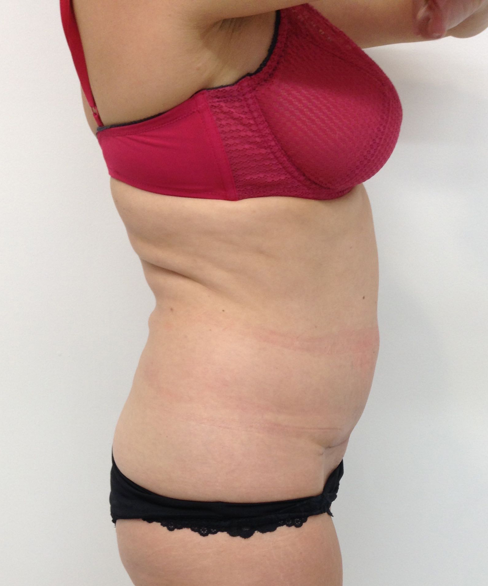 Abdominoplasty (Tummy Tuck) clinical image 12
