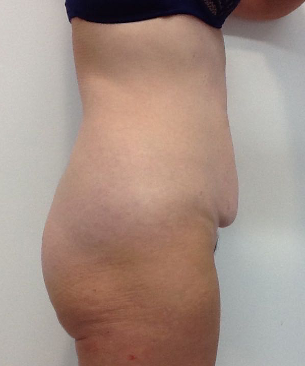 Abdominoplasty (Tummy Tuck) clinical image 14