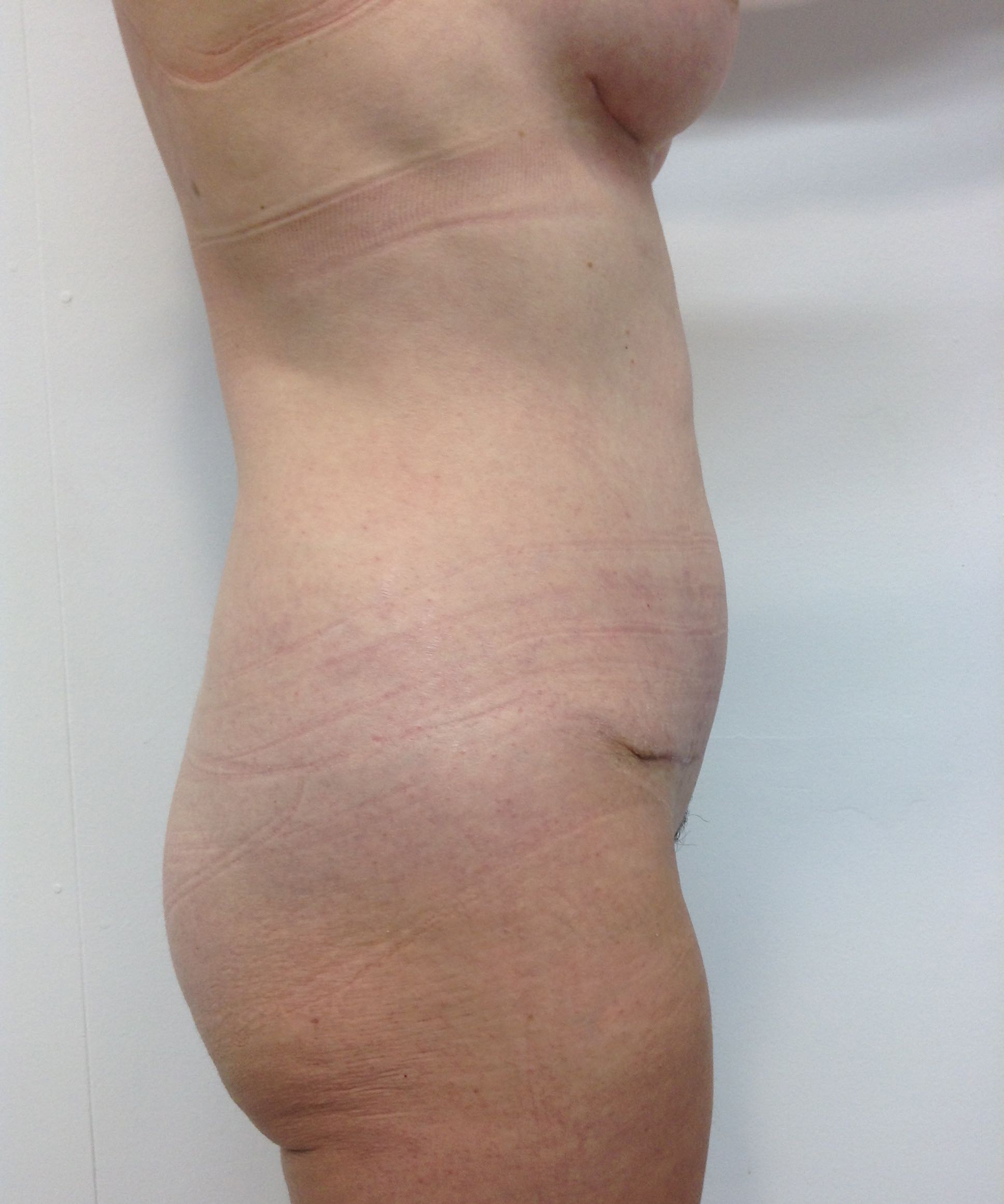 Abdominoplasty (Tummy Tuck) clinical image 16