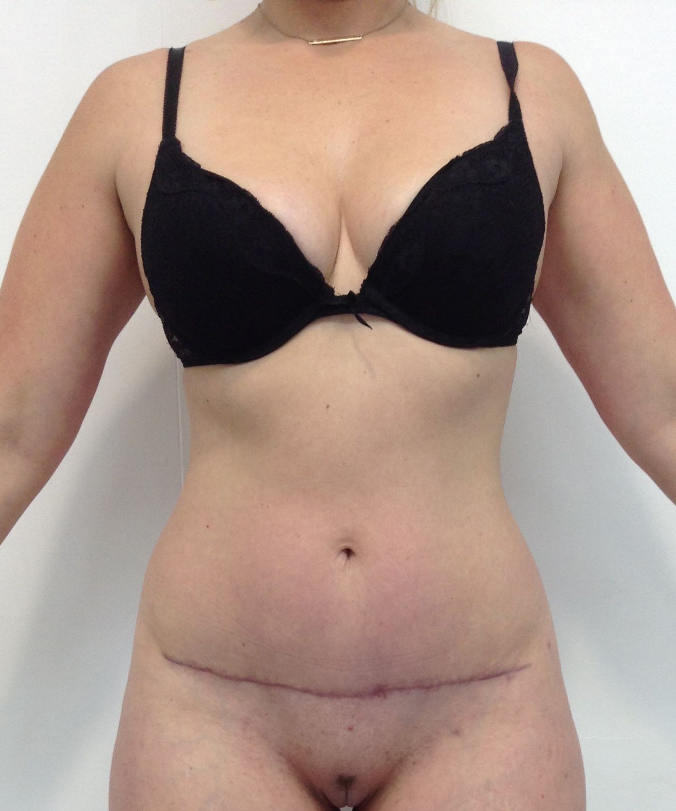 Abdominoplasty (Tummy Tuck) clinical image 19