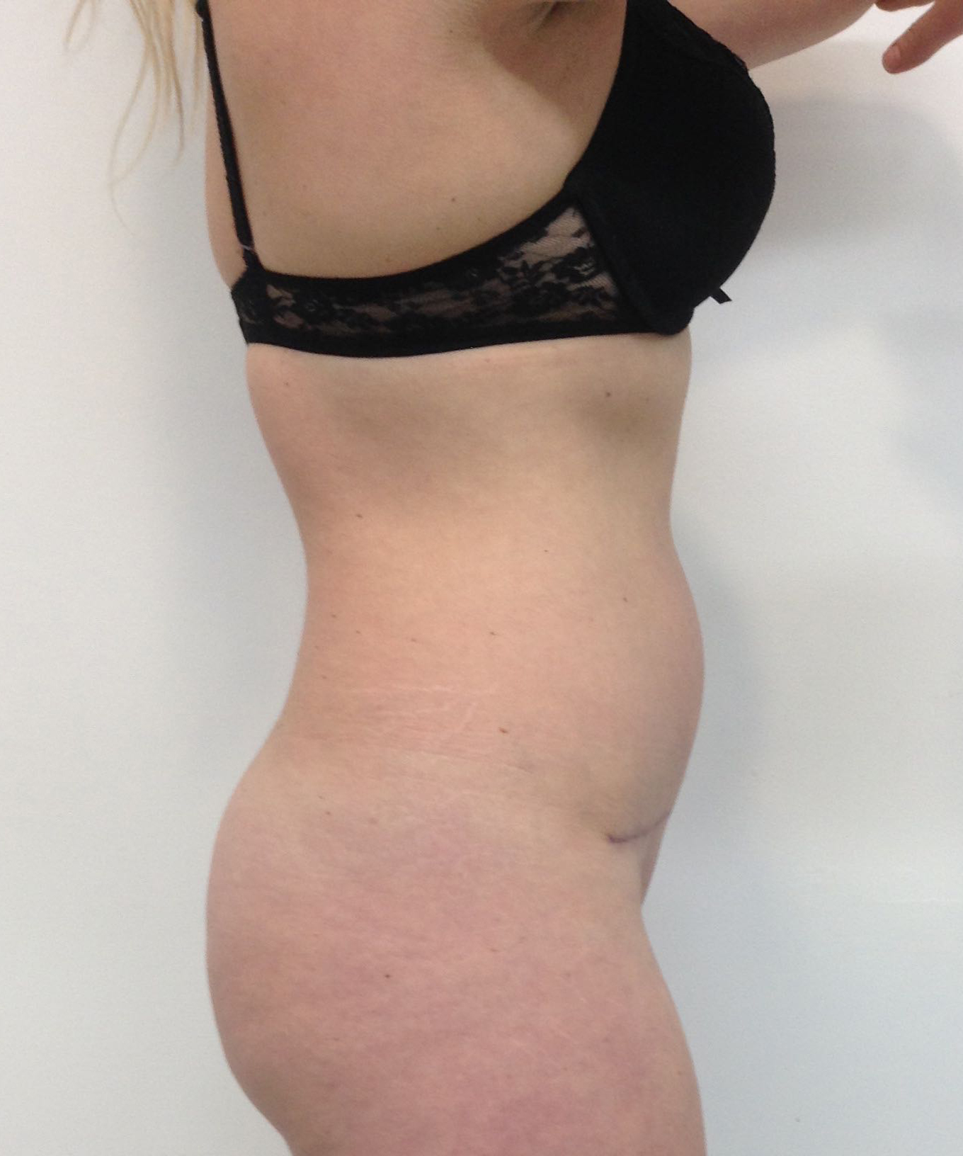 Abdominoplasty (Tummy Tuck) clinical image 20