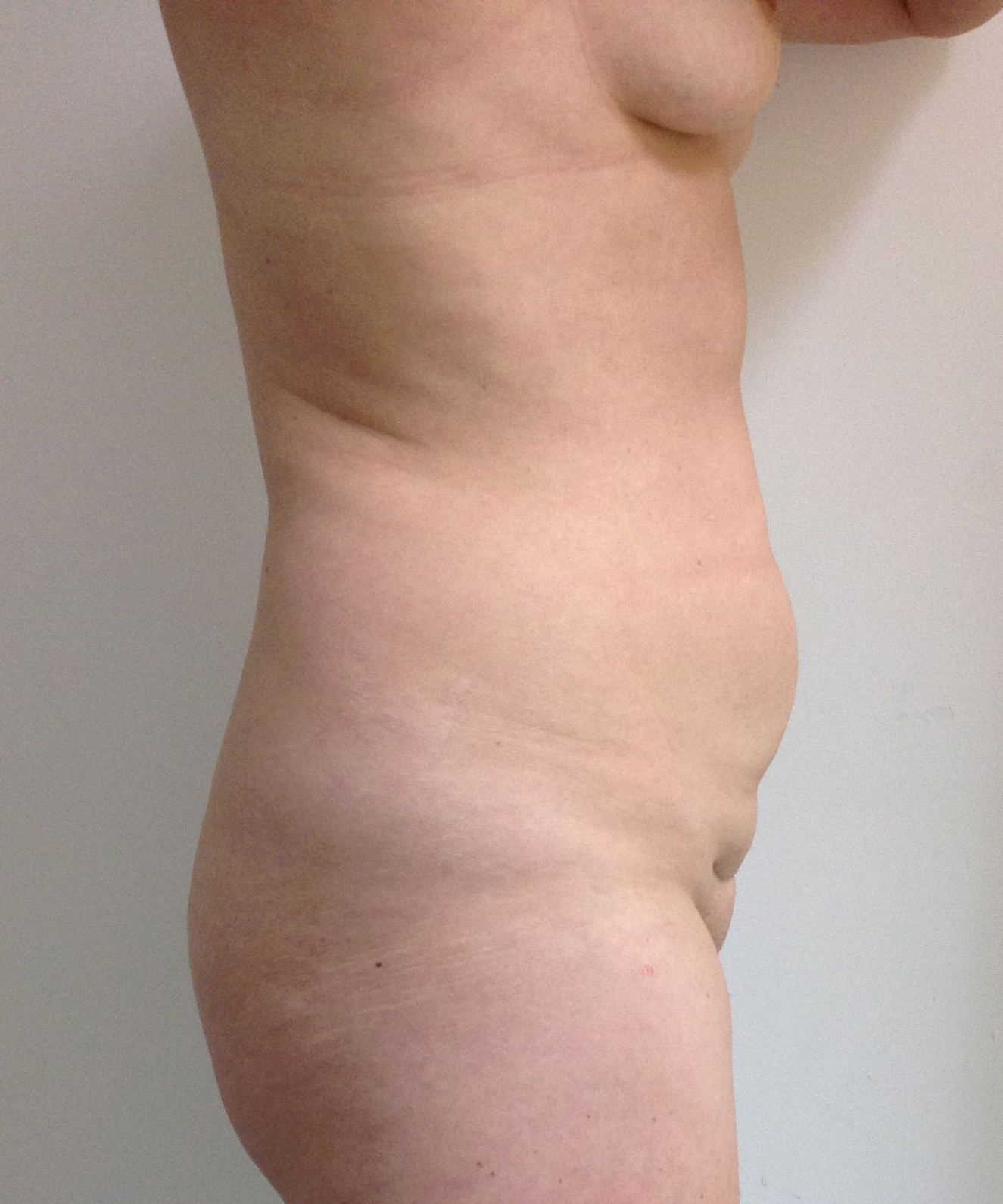 Abdominoplasty (Tummy Tuck) clinical image 22