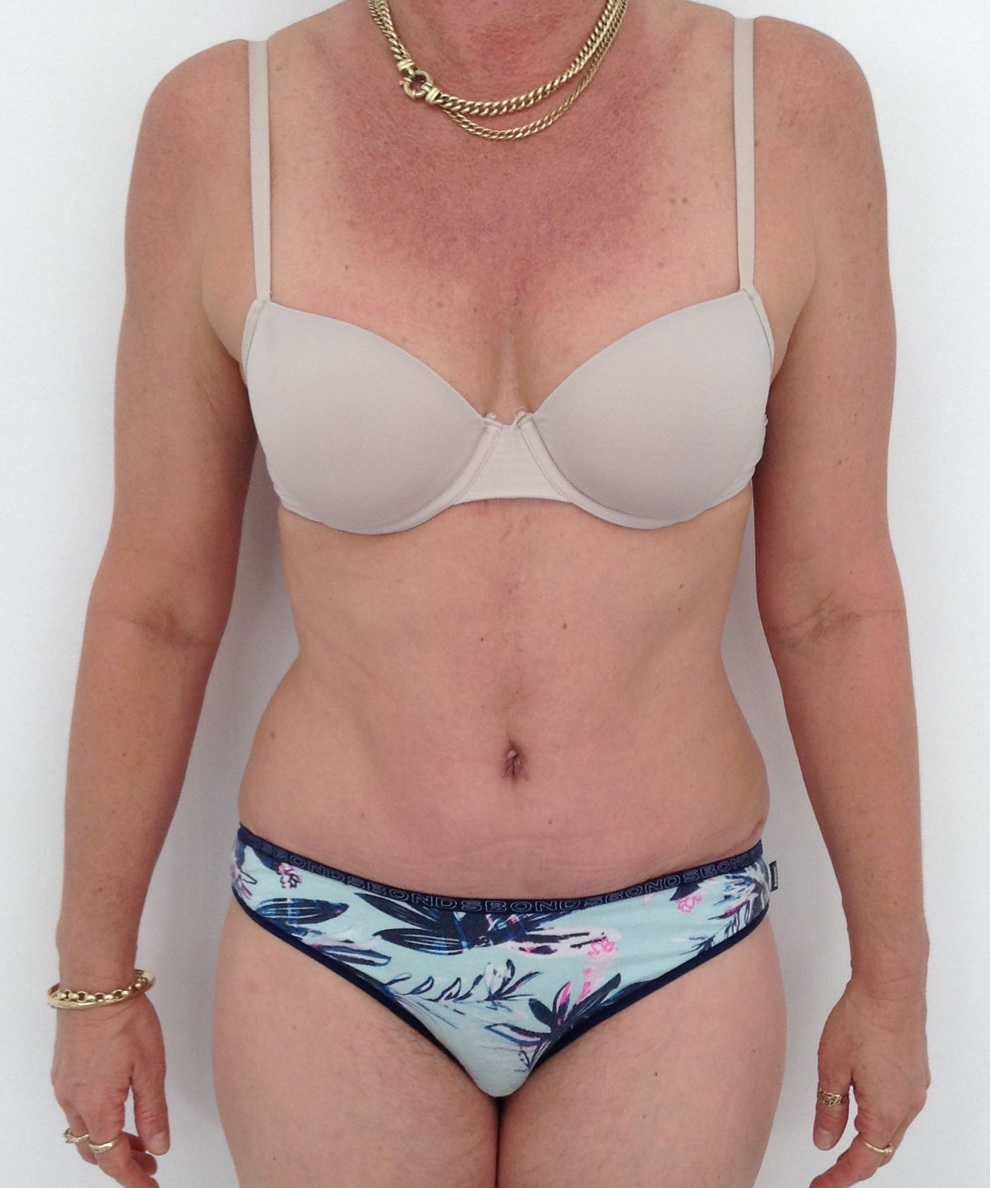 Abdominoplasty (Tummy Tuck) clinical image 23