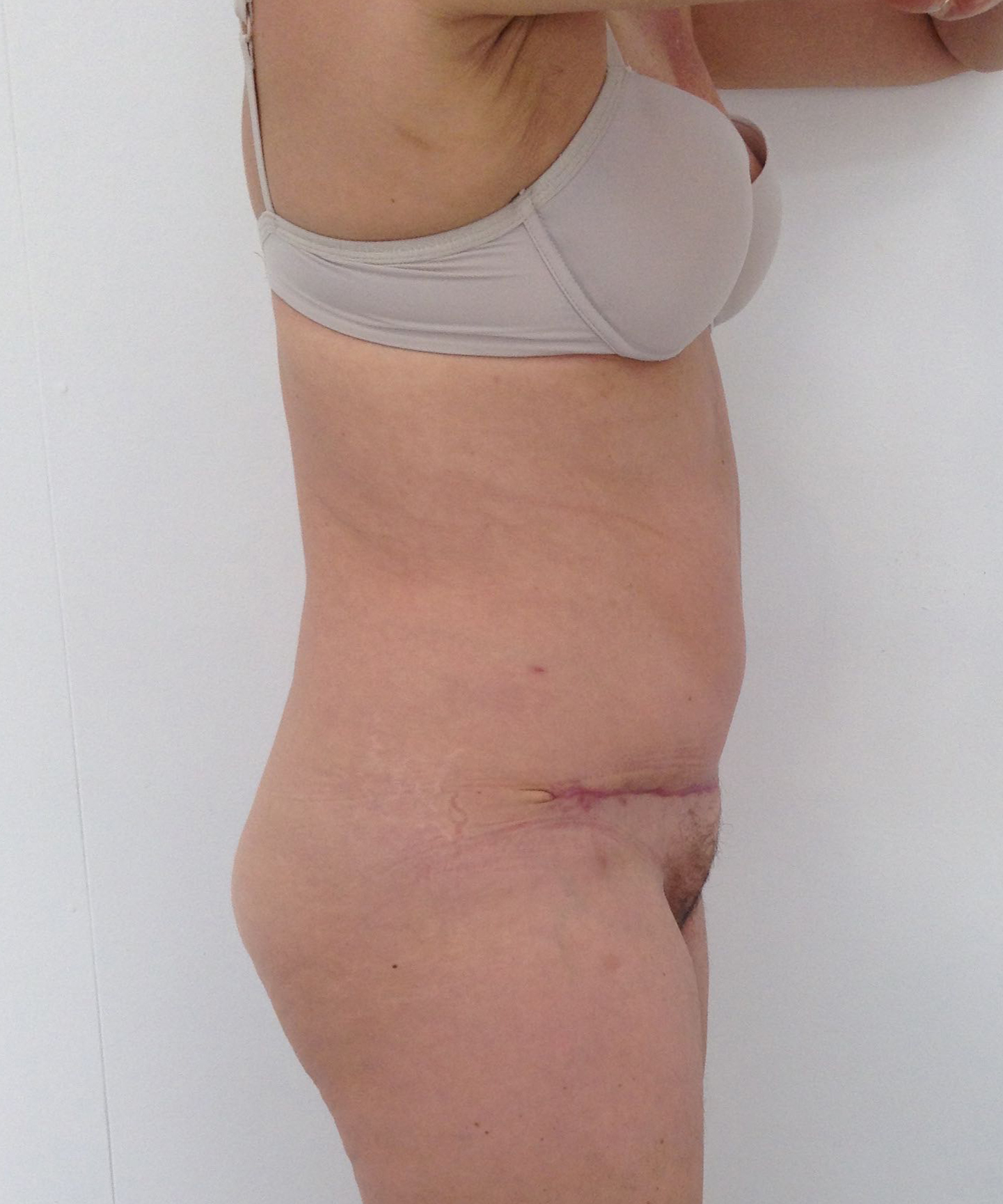 Abdominoplasty (Tummy Tuck) clinical image 24