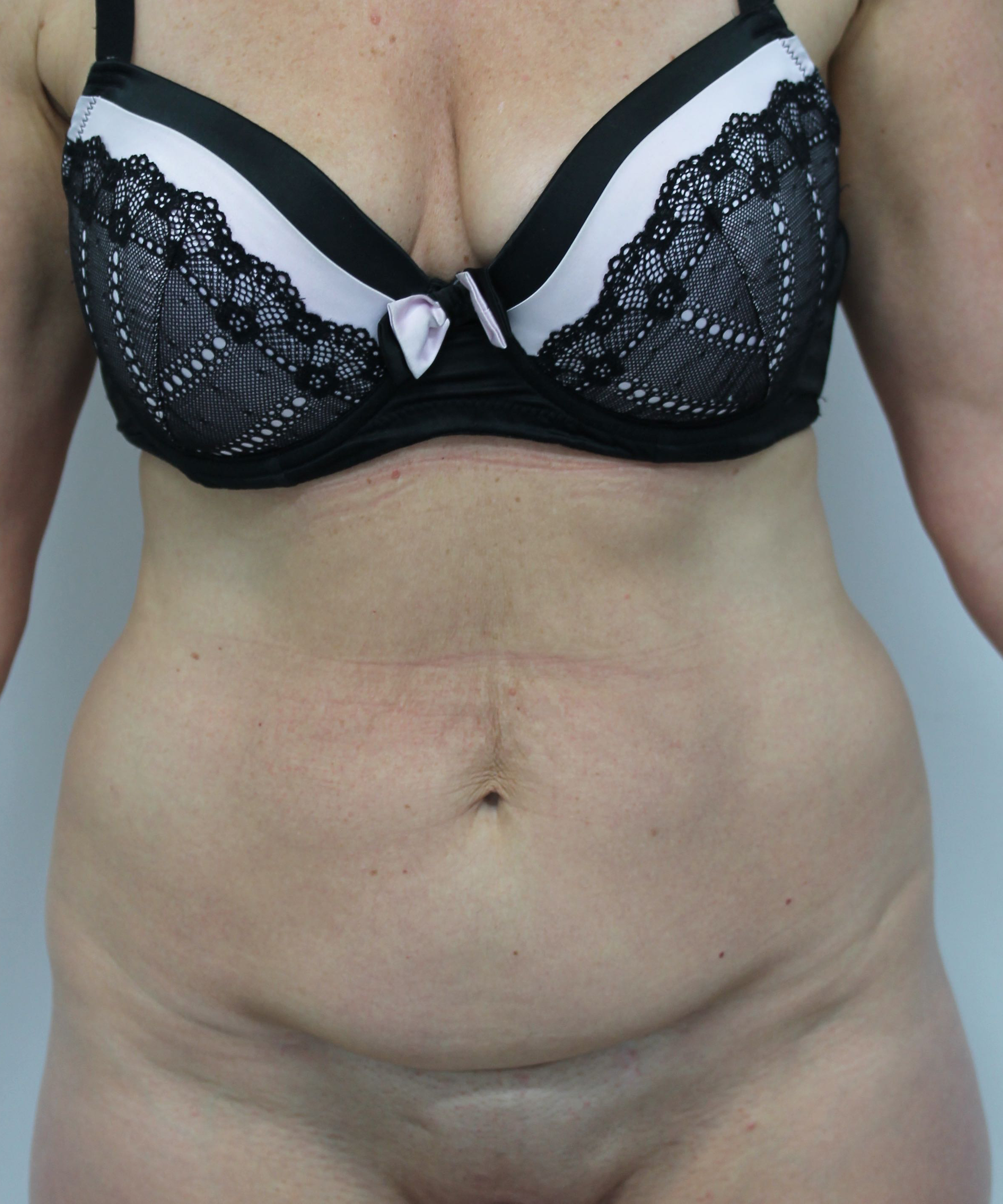 Abdominoplasty (Tummy Tuck) clinical image 25