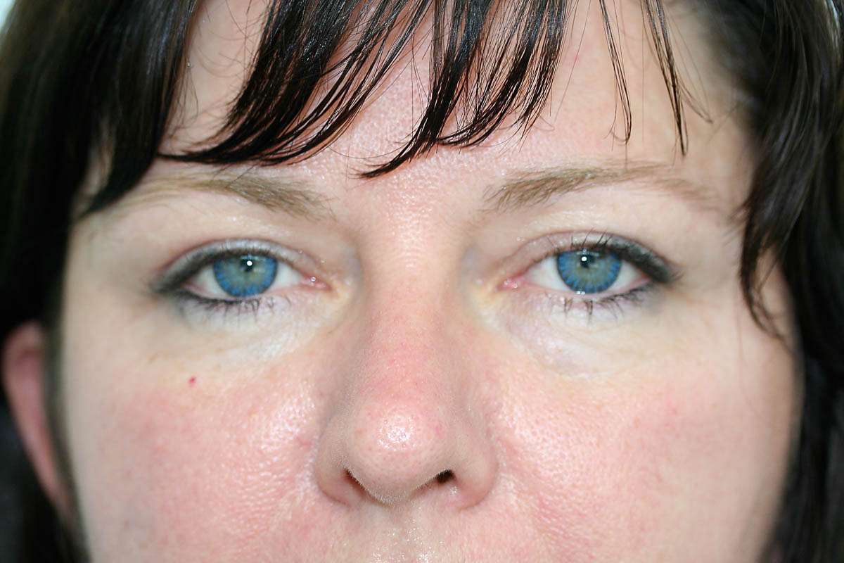 Blepharoplasty (Eyelid Surgery) clinical image 1