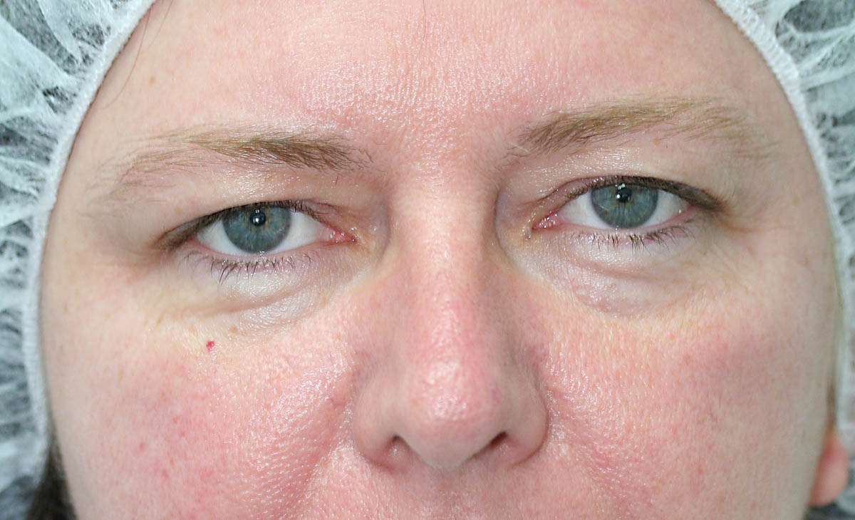 Blepharoplasty (Eyelid Surgery) clinical image 2