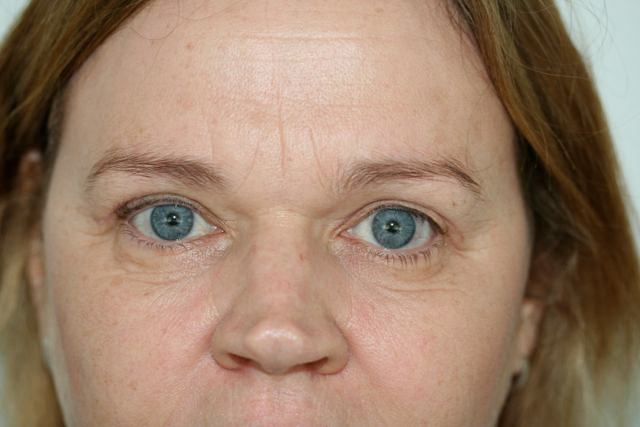 Blepharoplasty (Eyelid Surgery) clinical image 9