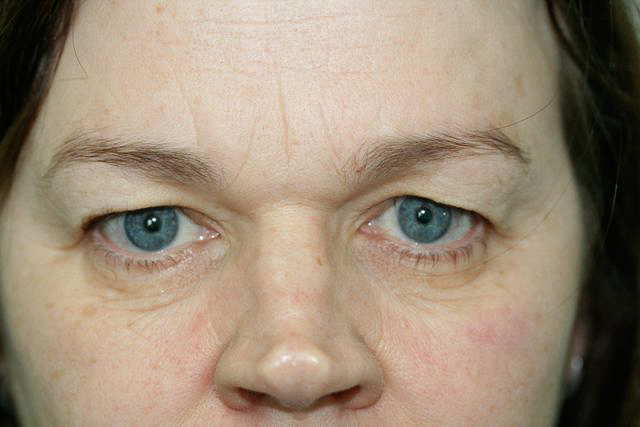 Blepharoplasty (Eyelid Surgery) clinical image 10