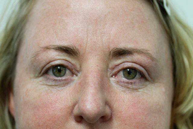 Blepharoplasty (Eyelid Surgery) clinical image 11