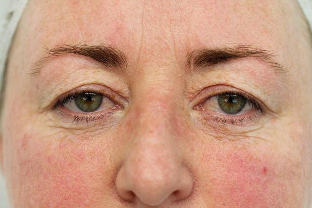 Blepharoplasty (Eyelid Surgery) clinical image 12