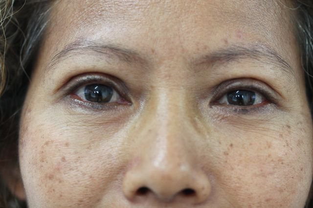 Blepharoplasty (Eyelid Surgery) clinical image 13