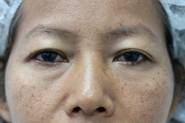 Blepharoplasty (Eyelid Surgery) clinical image 14