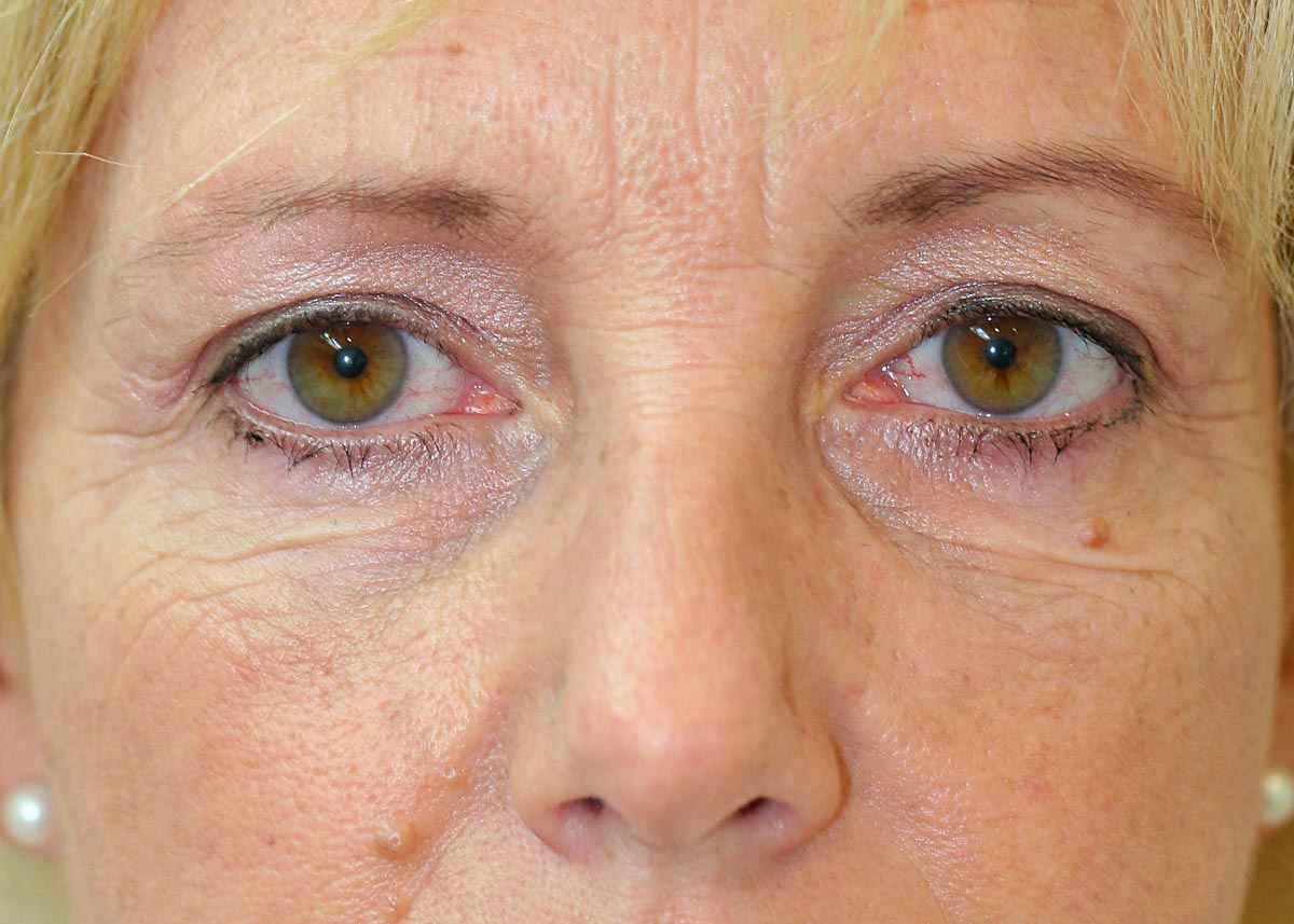 Blepharoplasty (Eyelid Surgery) clinical image 3