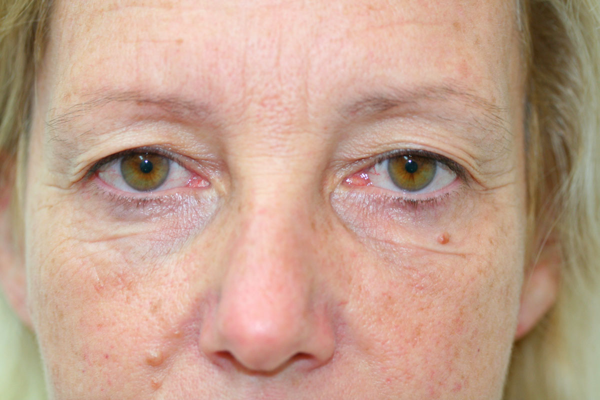 Blepharoplasty (Eyelid Surgery) clinical image 4