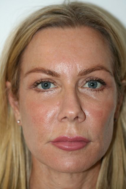 Blepharoplasty (Eyelid Surgery) clinical image 5