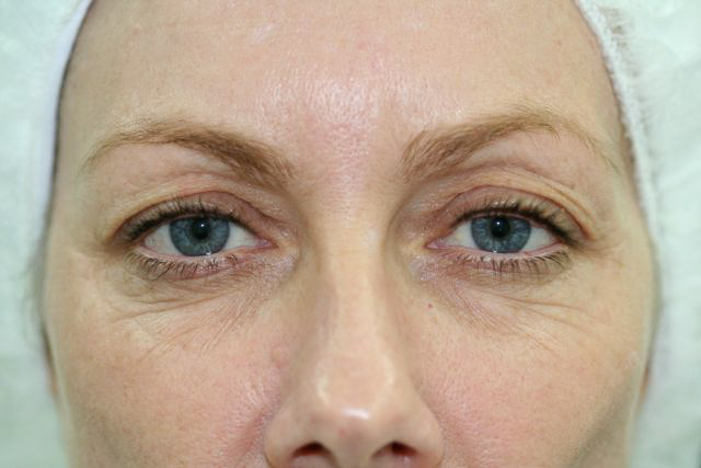 Blepharoplasty (Eyelid Surgery) clinical image 6