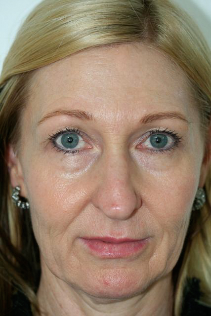 Blepharoplasty (Eyelid Surgery) clinical image 7