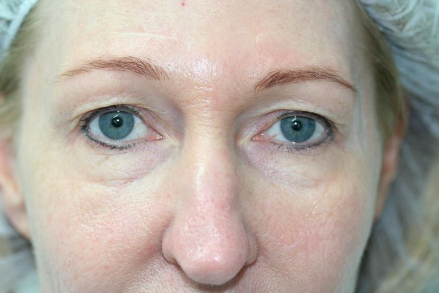 Blepharoplasty (Eyelid Surgery) clinical image 8