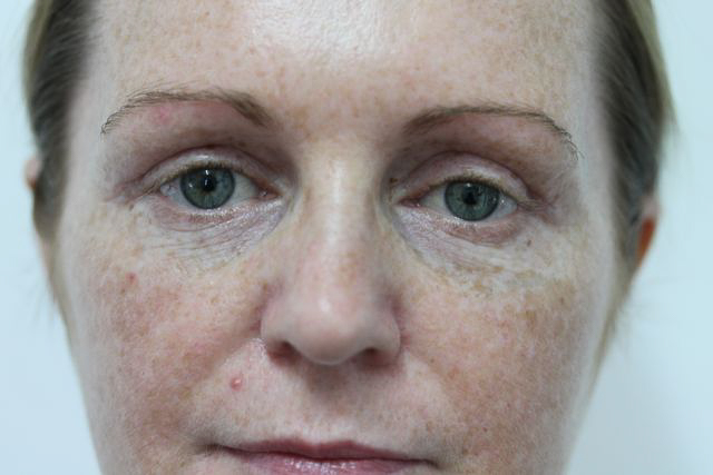 Blepharoplasty (Eyelid Surgery) clinical image 15