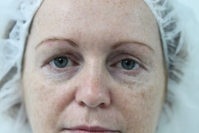 Blepharoplasty (Eyelid Surgery) clinical image 16