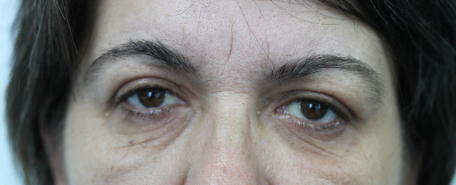 Blepharoplasty (Eyelid Surgery) clinical image 17