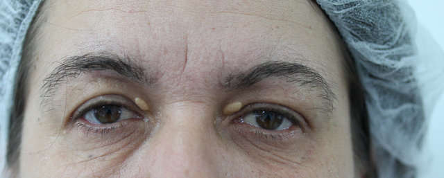 Blepharoplasty (Eyelid Surgery) clinical image 18