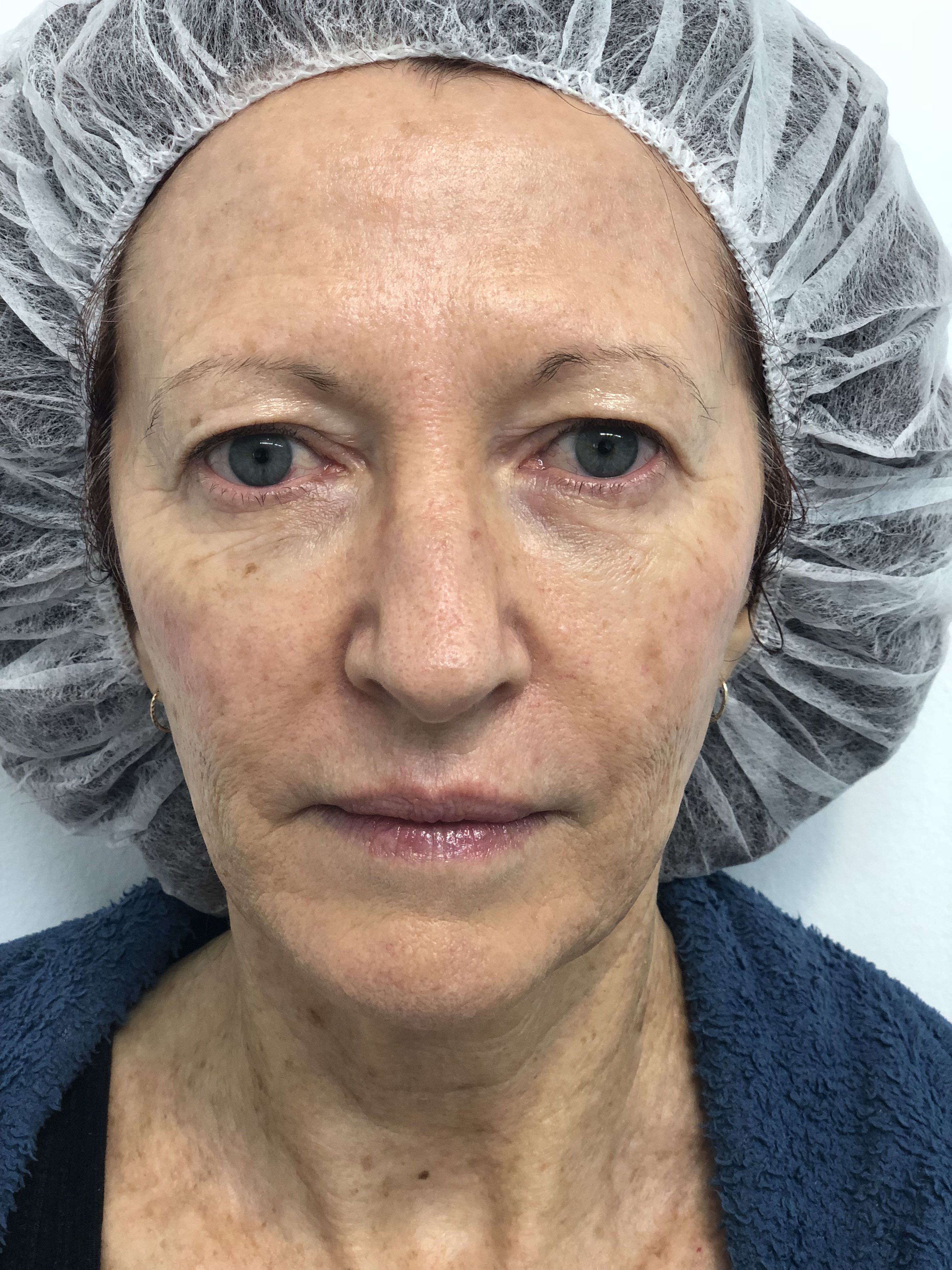 Blepharoplasty (Eyelid Surgery) clinical image 19