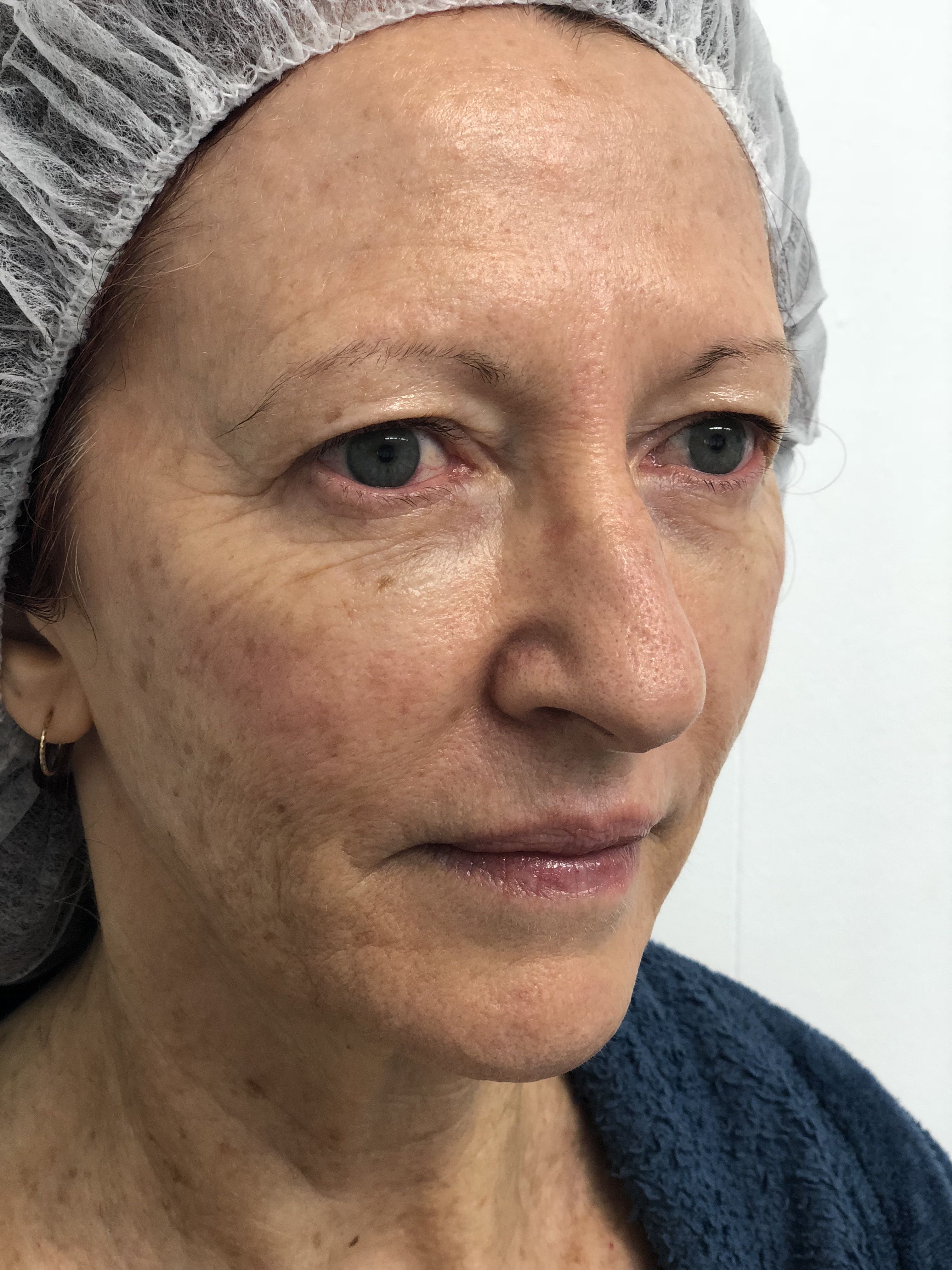 Blepharoplasty (Eyelid Surgery) clinical image 20