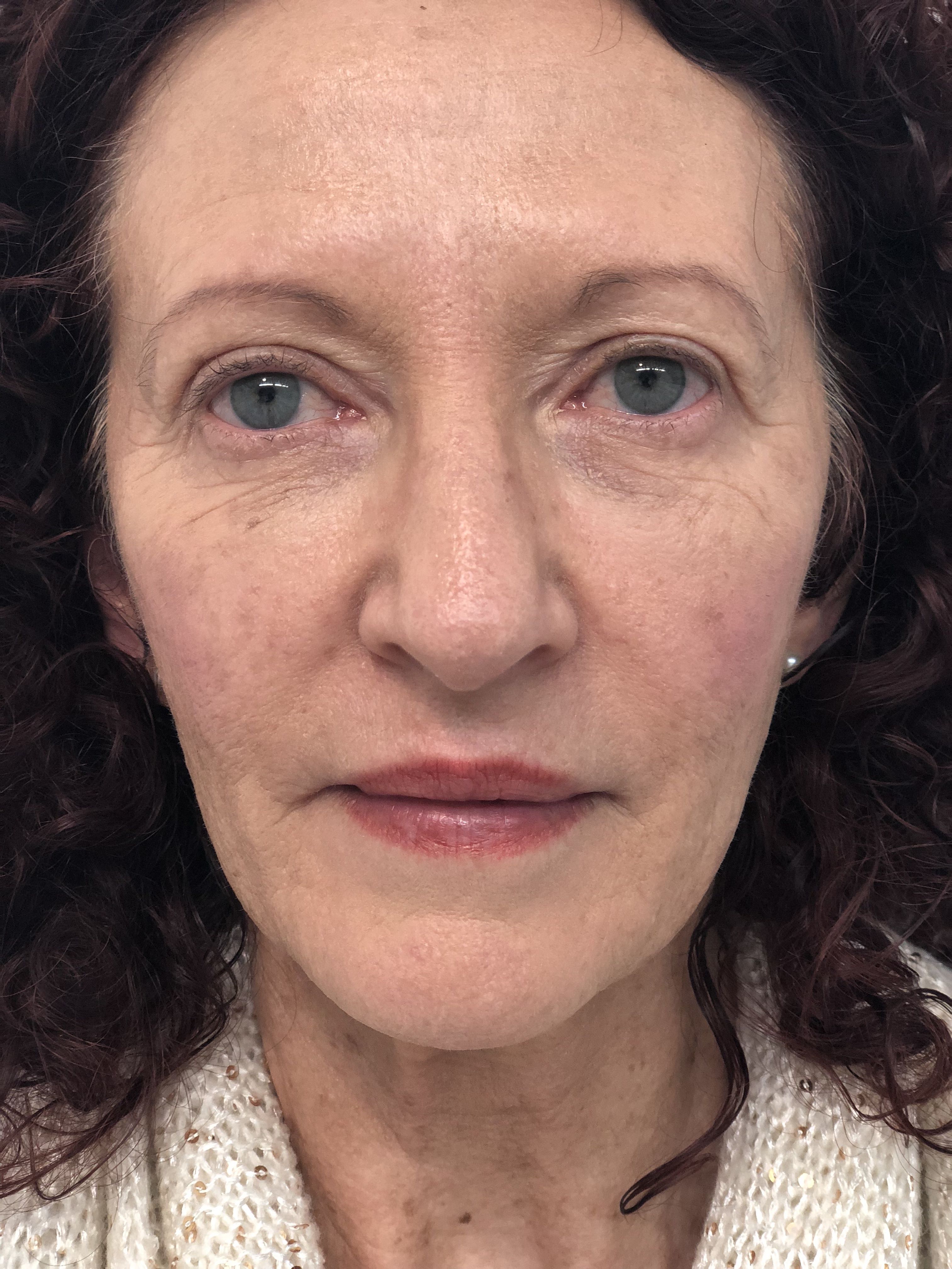 Blepharoplasty (Eyelid Surgery) clinical image 21