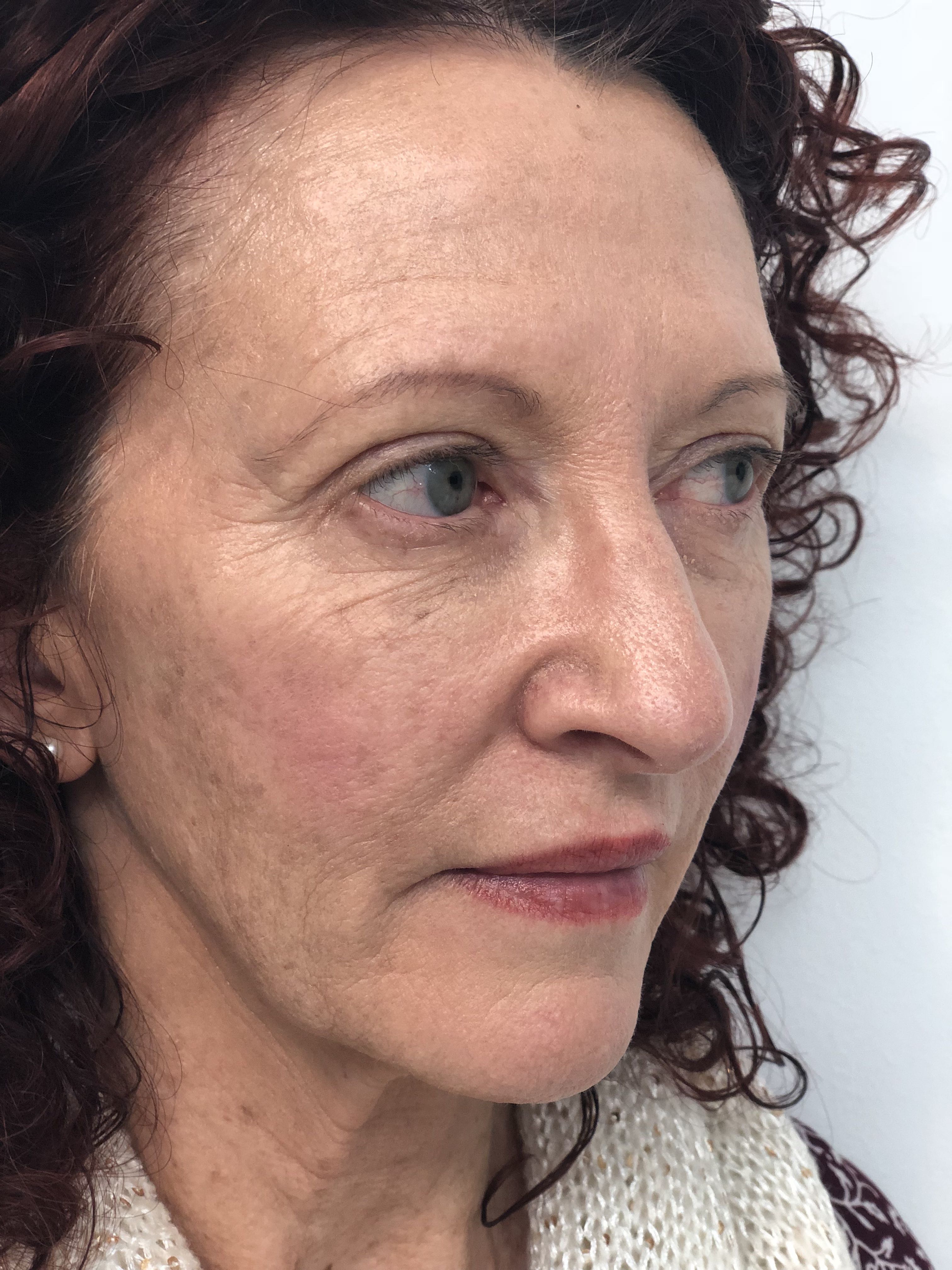 Blepharoplasty (Eyelid Surgery) clinical image 22