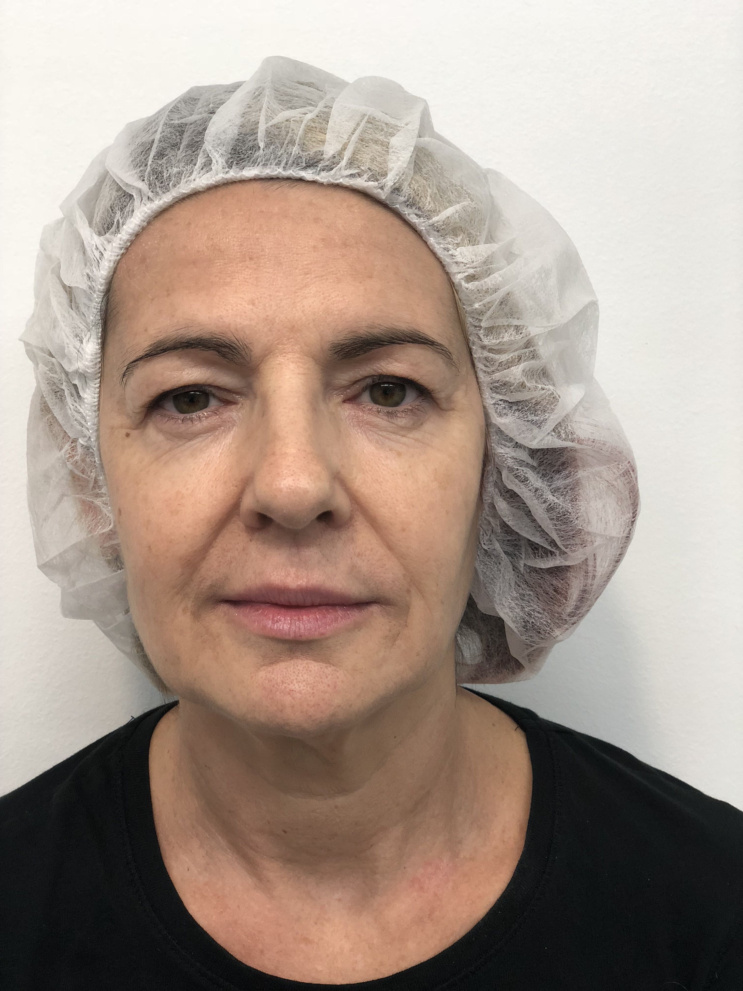 Blepharoplasty (Eyelid Surgery) clinical image 23