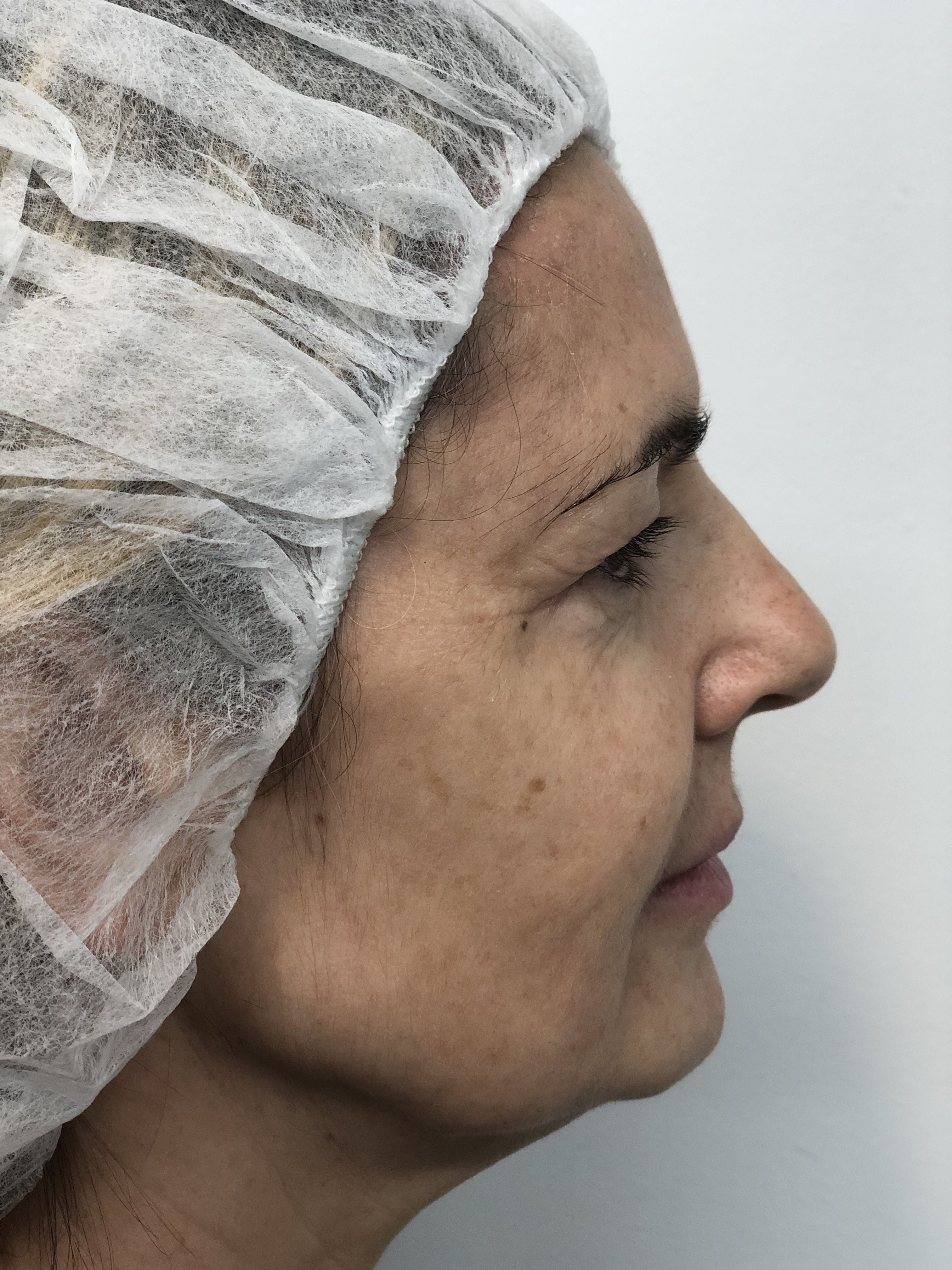 Blepharoplasty (Eyelid Surgery) clinical image 24