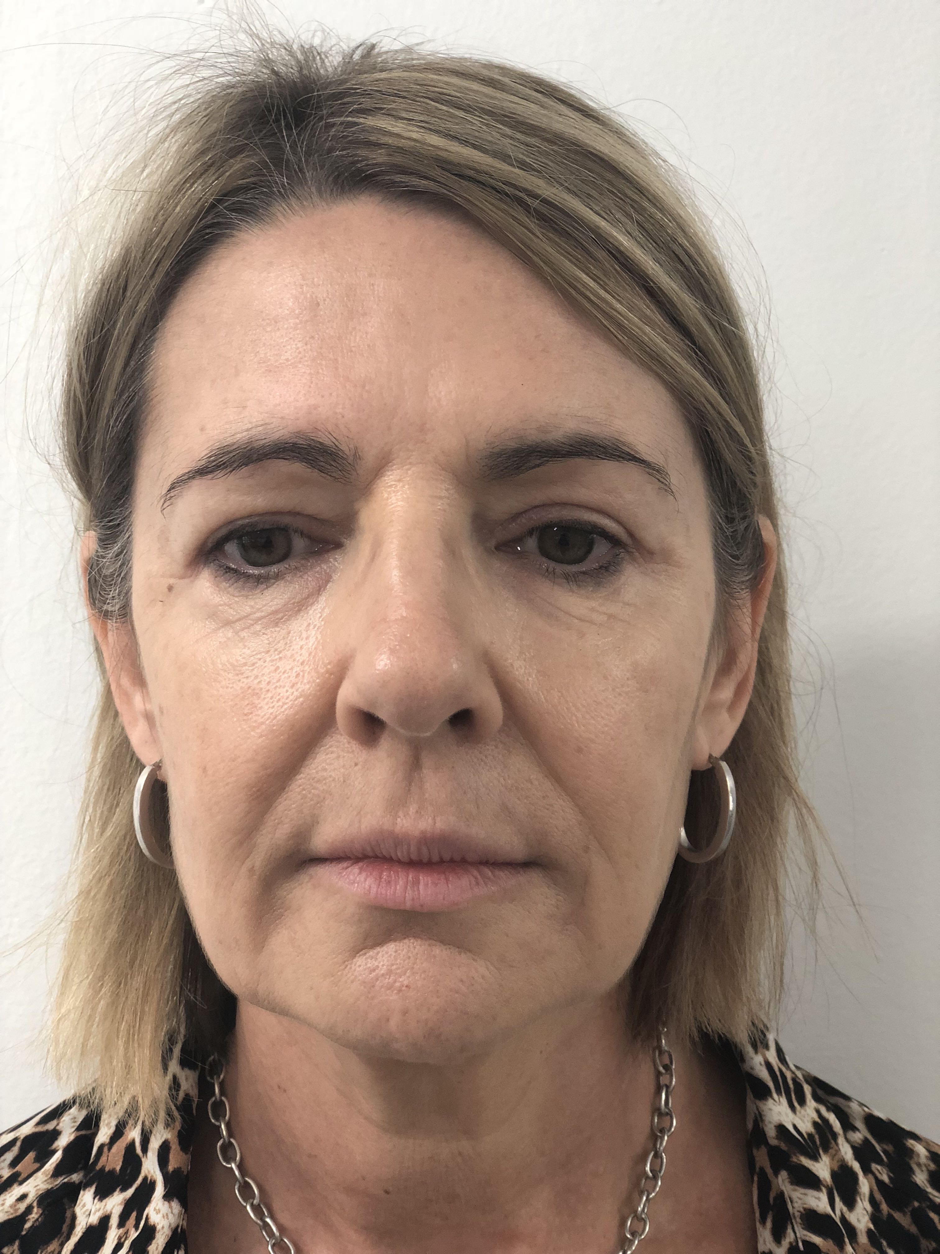 Blepharoplasty (Eyelid Surgery) clinical image 25