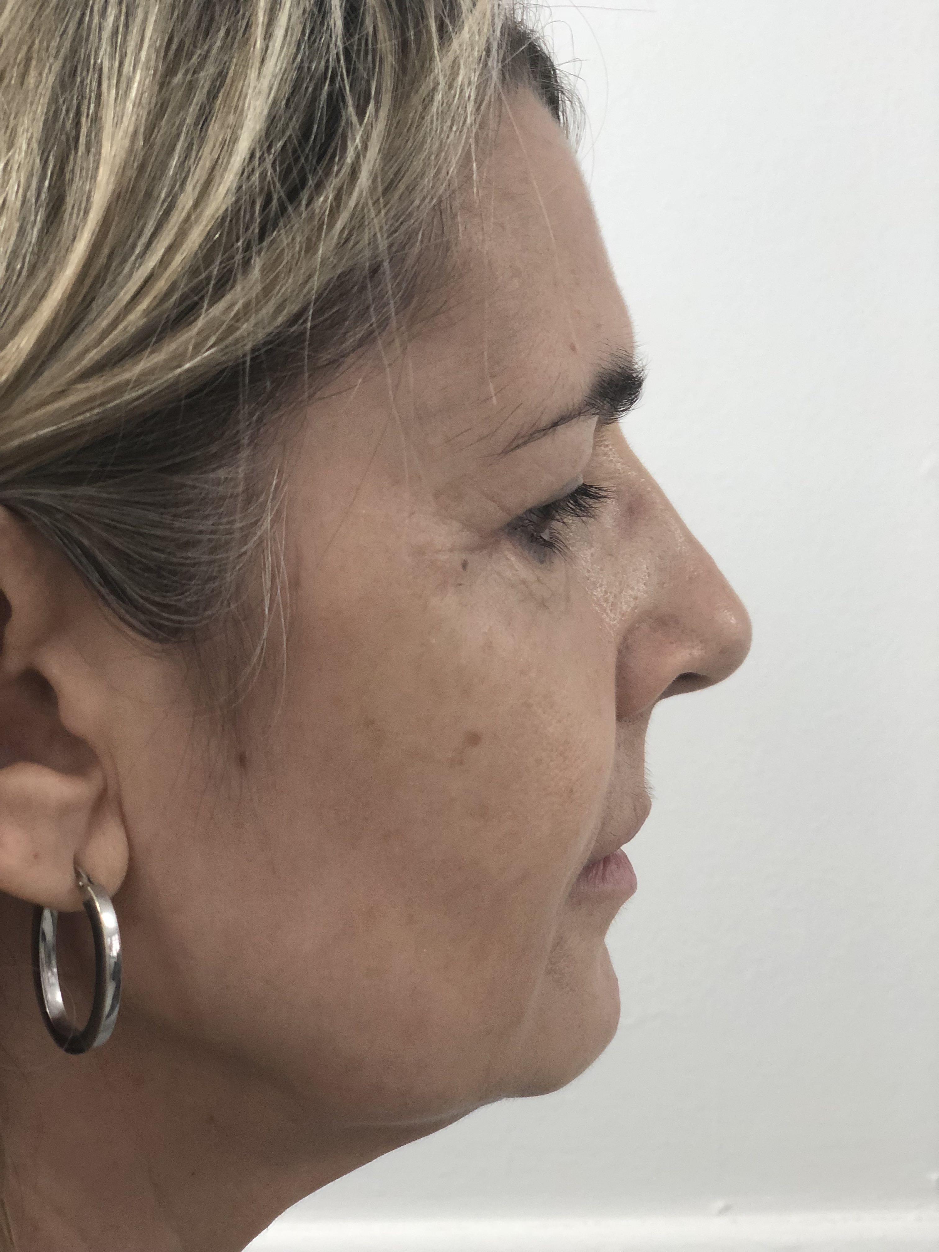 Blepharoplasty (Eyelid Surgery) clinical image 26