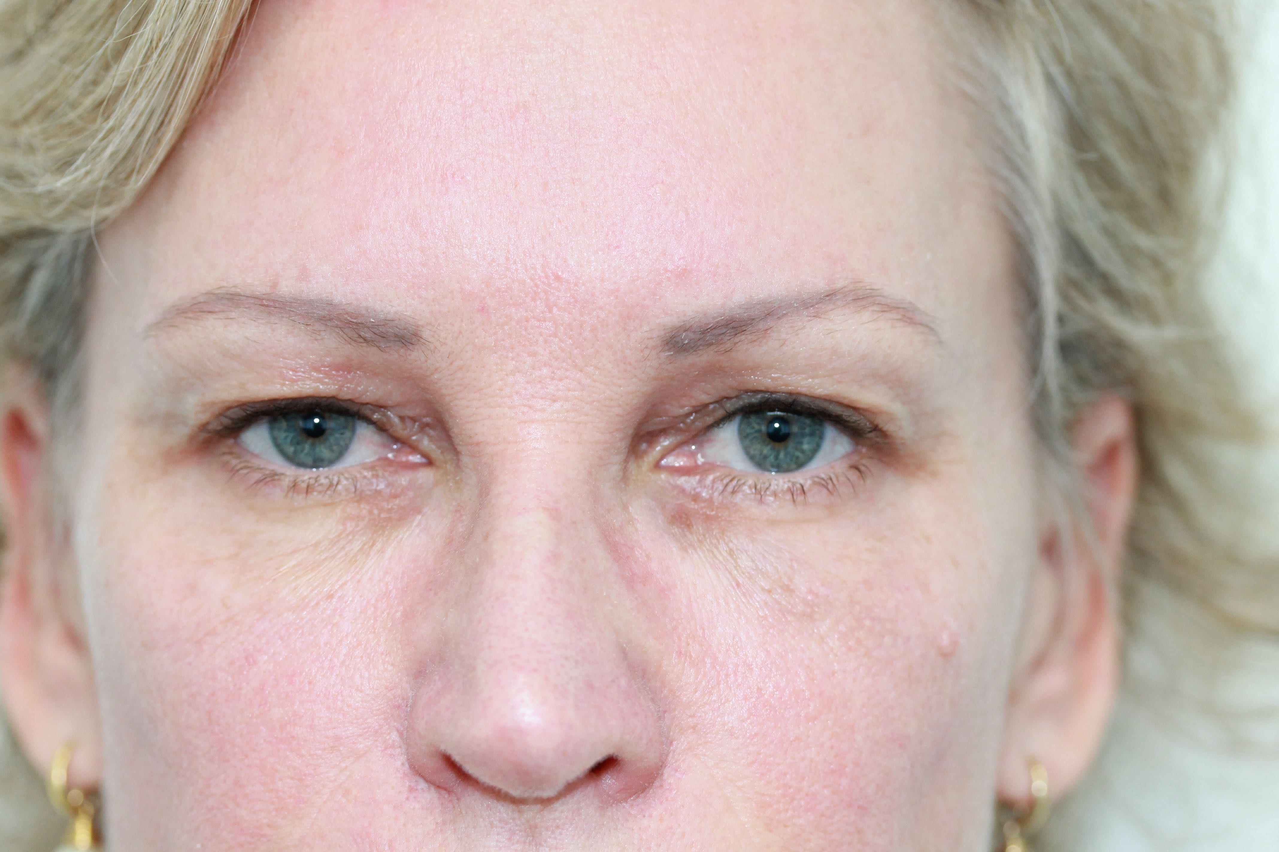 Blepharoplasty (Eyelid Surgery) clinical image 27